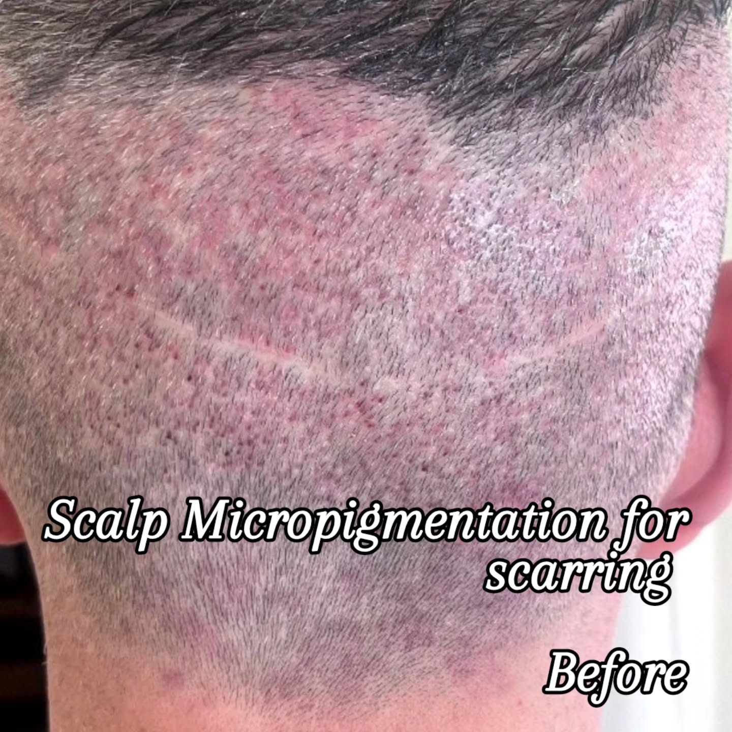 Scalp Micropigmentation to mask the appearance of scars!
This procedure is performed and used to replicate hair follicles on the scalp! On this particular client, we performed this procedure to mask the appearance of a large scar across the back of his skull.
Honestly, I could not ask for a more perfect result!
Traditionally, this procedure is performed for male pattern baldness or thinning hair on women!
✔️ Can be performed on any hair color
✔️ Can be done on men or women
✔️ Used for a male pattern baldness
✔️ Used for density fills, for women with thinning hair
✔️ Also used to mask scars as seen here
Click BOOK NOW at www.stayinkd.com or on FB or Instagram. 📞 or text 904-933-INKD with any questions.
#scalpmicropigmentation
#scalpscar #thinninghair #malepatternbaldness #paramedicaltattooing