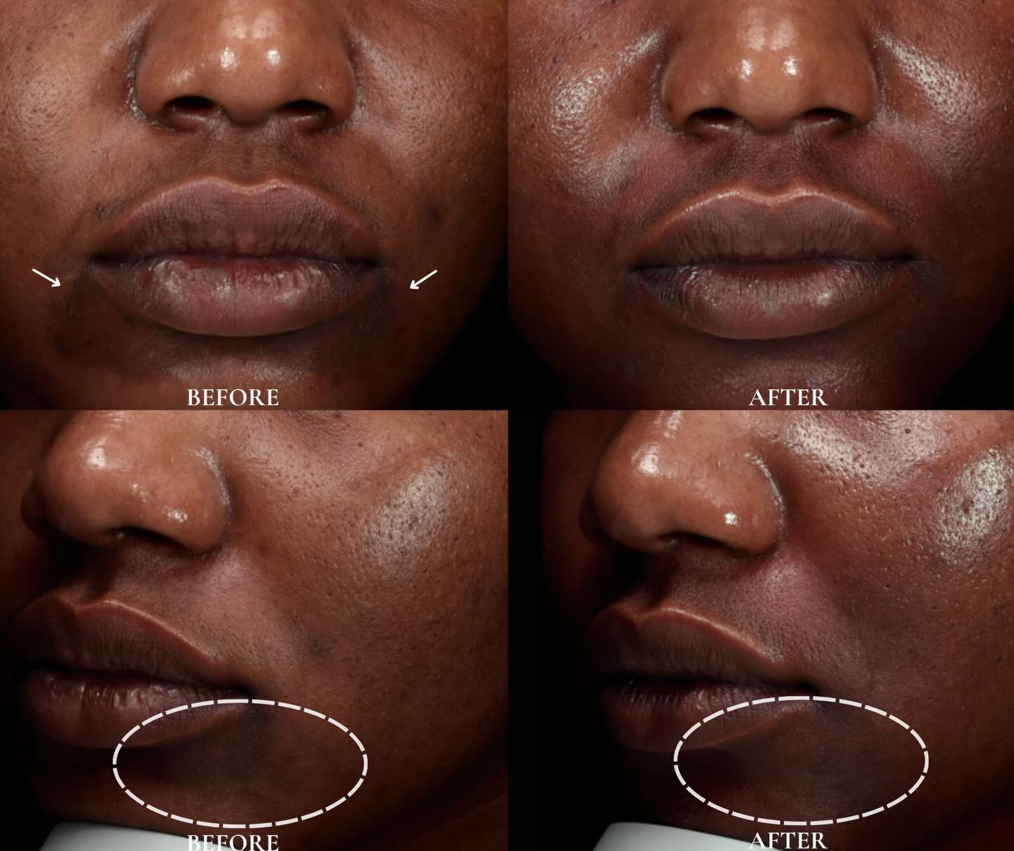✨ Targeted pigmentation correction, elevated.
This transformation shows how Helios toning can visibly soften stubborn pigmentation around the mouth area—one of the most challenging zones to treat.
Melanin-rich skin requires precision, not aggression. With the right wavelength and controlled energy, we’re able to:
• Gradually lift uneven pigmentation
• Improve overall skin clarity
• Maintain skin integrity without over-irritation
No harsh peeling. No downtime. Just progressive, refined results.
Pigmentation is never a one-session fix—but with the right protocol, the skin does respond.
DM to start your customized skin journey 🤍
#PigmentationTreatment #MelaninSkin #LaserToning #HeliosLaser