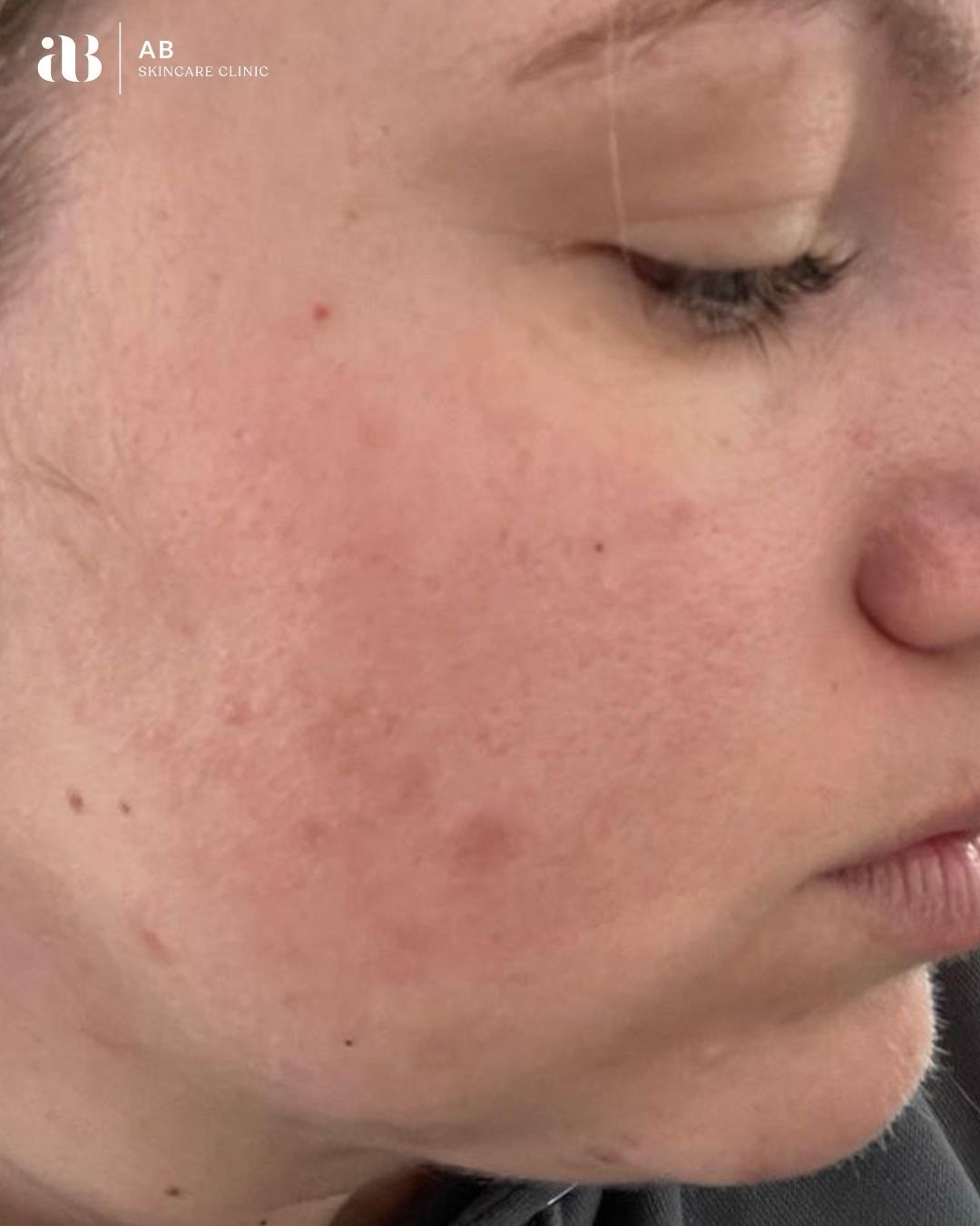 This result is a perfect example of why skin health must always come before quick fixes.
When this client first came to the clinic she was experiencing breakout-prone skin alongside a compromised skin barrier. Before we could focus on clearing the acne, our priority was to repair, strengthen and rebalance the skin barrier: the foundation of healthy skin.
Over the course of three months, through a combination of targeted professional treatments, carefully curated home skincare, and tailored lifestyle recommendations, we were able to restore the integrity of the skin. As the barrier strengthened, inflammation reduced and the skin naturally began to clear.
Acne is never an overnight fix, and there is no single “miracle treatment.” The skin is a complex, intelligent organ that reflects what is happening internally as much as externally. Factors such as gut health, hormonal balance, environmental stressors, product misuse and lifestyle habits can all contribute to breakouts.
This is why @abskincareclinic we take a true 360° approach to skin health.
Prioritising long-term skin health over temporary results.
In many cases, the most effective starting point isn’t always an advanced treatment. It may simply begin with lifestyle changes, product adjustments, dietary guidance, or targeted supplementation to support the skin from within.
By respecting the skin’s natural biology and allowing the process to unfold properly, we can create results that are not only visible, but sustainable.
📣 RELEASING SOON is my new 360° Skin Programme; a comprehensive approach designed to address skin concerns from every angle, both internally and externally.
Initial spaces will be extremely limited.
Send this to a friend who you feel could benefit from our 360° Skin Programme & DM me SKIN if you are interested in joining the programme/finding out more 🫶
