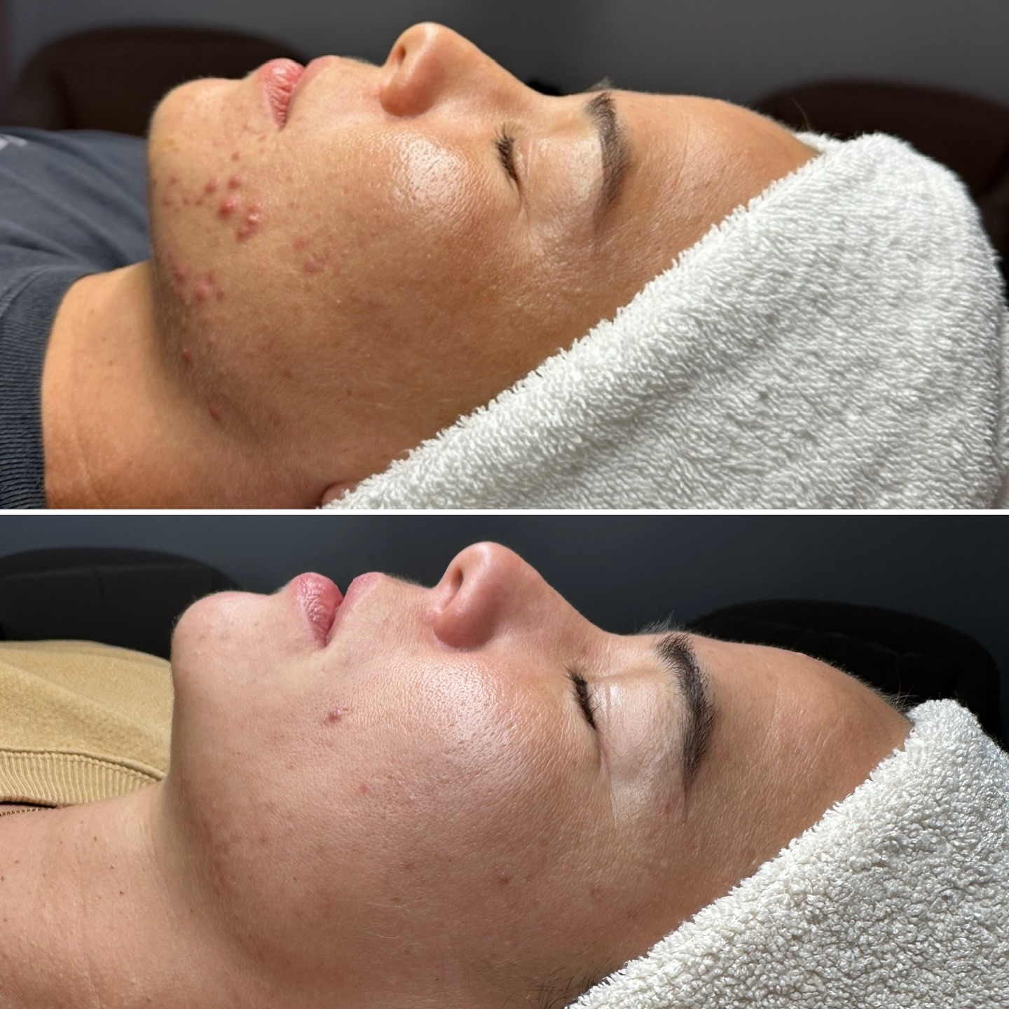 Okay but can we talk about her skin for a second?? Cystic acne who? I am so happy with her progress 🥹 She came in ready to commit and we got to work — custom home care, lifestyle shifts, exfoliating enzymes, and now a peel series targeting clarity, texture, and scarring. And honestly? This is just the beginning for her!!
Ready to get your skin under control? Book an Acne Consultation through link in bio!