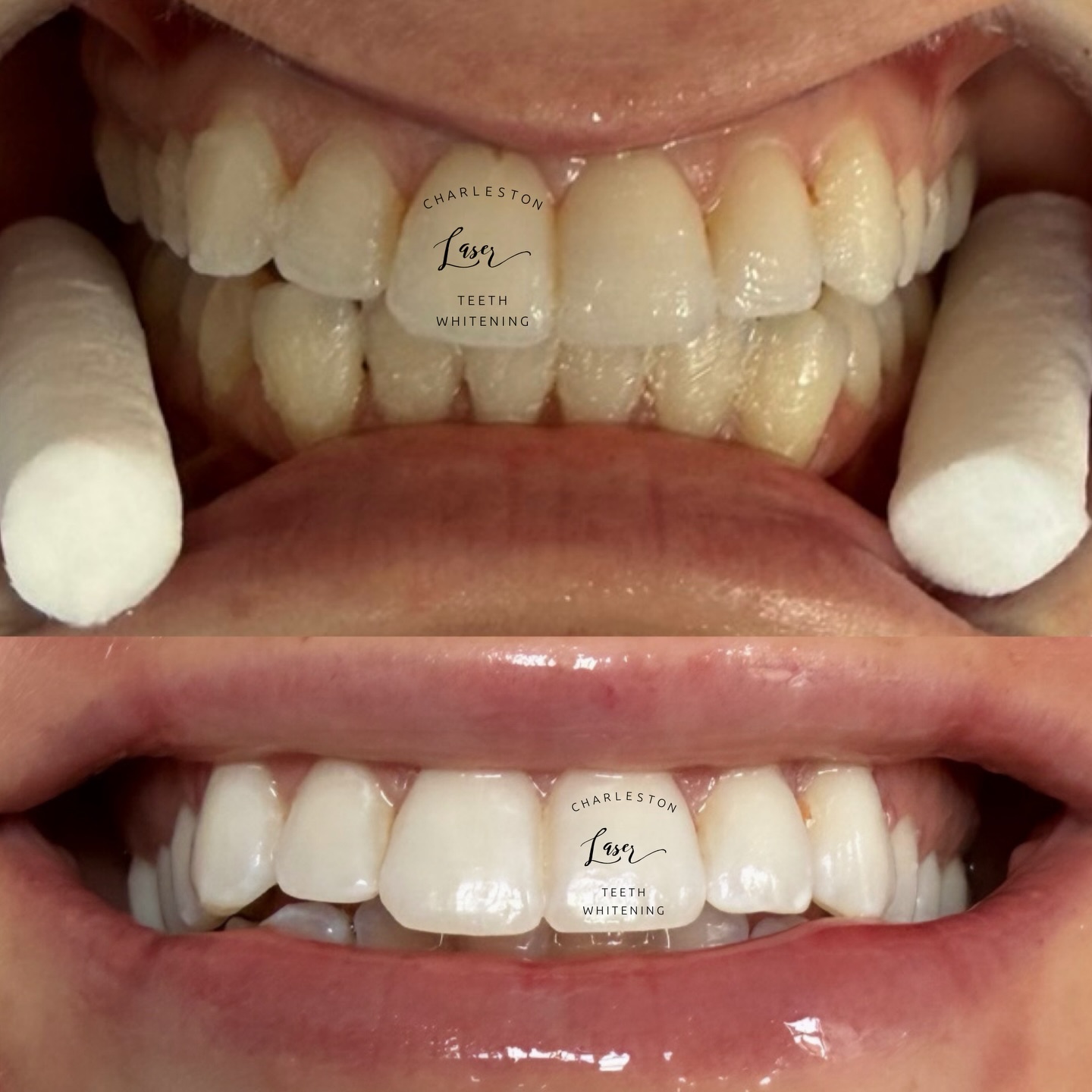 Hurry! Don't Miss Our Easter Teeth Whitening Sale!
🐣10% off a 1 Hour Teeth Whitening
Reg. $200 Sale $180
🐣15% off a TWO 1 Hour Teeth Whitenings
Reg. $400 Sale $340
🐣25% off FOUR 1 Hour Teeth Whitenings
Reg. $800 Sale $600
Buy Now!
www.CharlestonTeethWhitening.com
Book Later
www.CharlestonLaserTeethWhitening.com
#teethwhitening #charlestonteethwhitening #charleston #charlestonsc #charlestonlaserteethwhitening mountpleasant mountpleasantsc kiawahisland kiawahjamesisland westashley isleofpalms downtowncharleston sullivansisland johnsisland johnsisland northcharleston northcharlestonsc folly follybeach laserteethwhitening