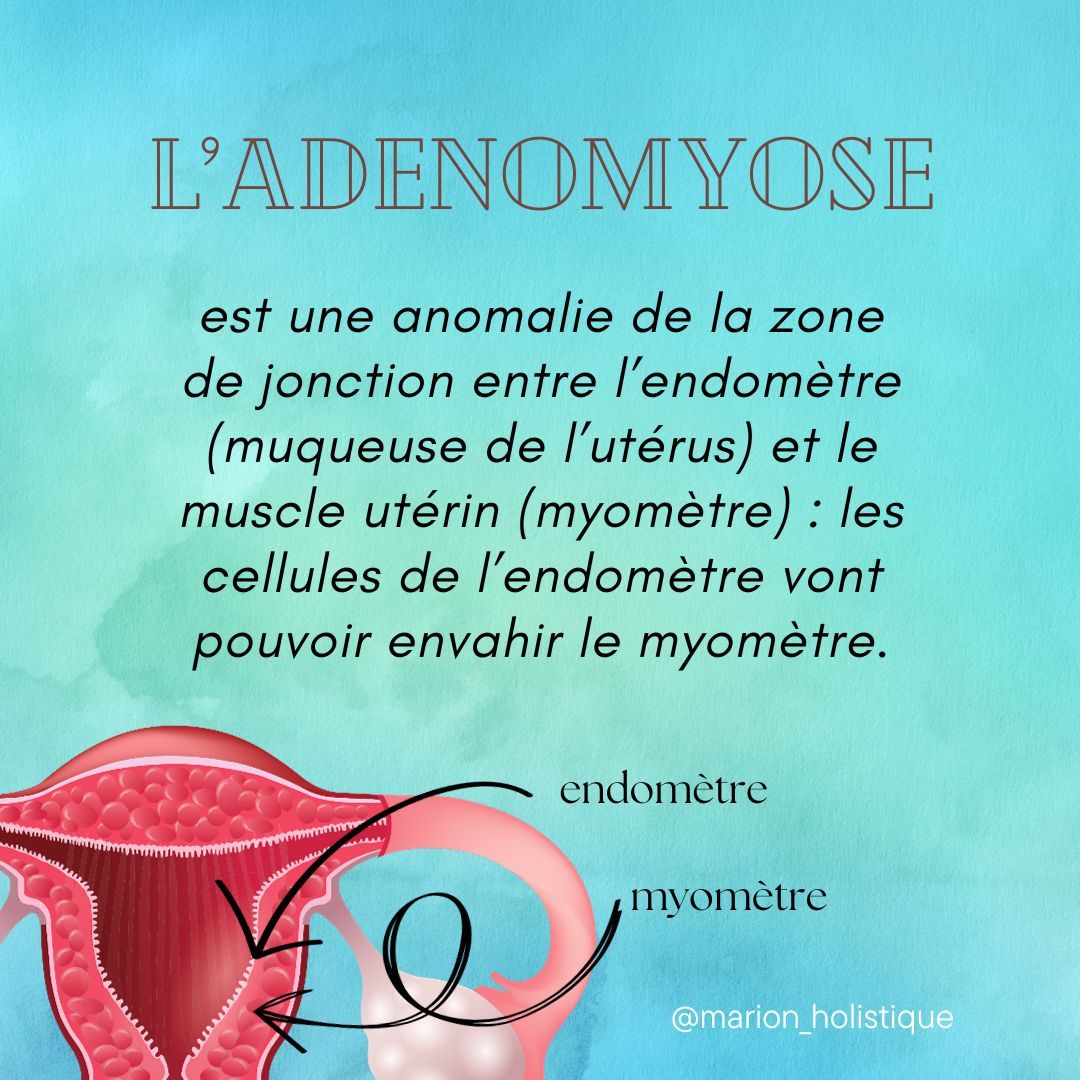 L'adénomyose qui est souvent confondue avec l'endométriose, alors qu’elle n’est pas forcément associée, est encore plus mal connue.
Elle est pourtant à l'origine de douleurs importantes, de fatigue par la perte de sang, et donc d'une dégradation de leur qualité de vie.
Le ventre douloureux et gonflé pendant les règles, des saignements importants ou en dehors des règles peuvent alerter. Parlez-en à votre médecin ! L'acupuncture, discipline de la médecine traditionnelle chinoise, apporte un vrai soulagement. Elle m'a accompagnée depuis mon diagnostic jusqu'à aujourd'hui !
#adenomyose #adenomyosis #endometriose #endométriose #infoendometriose #kezako #paroisuterine