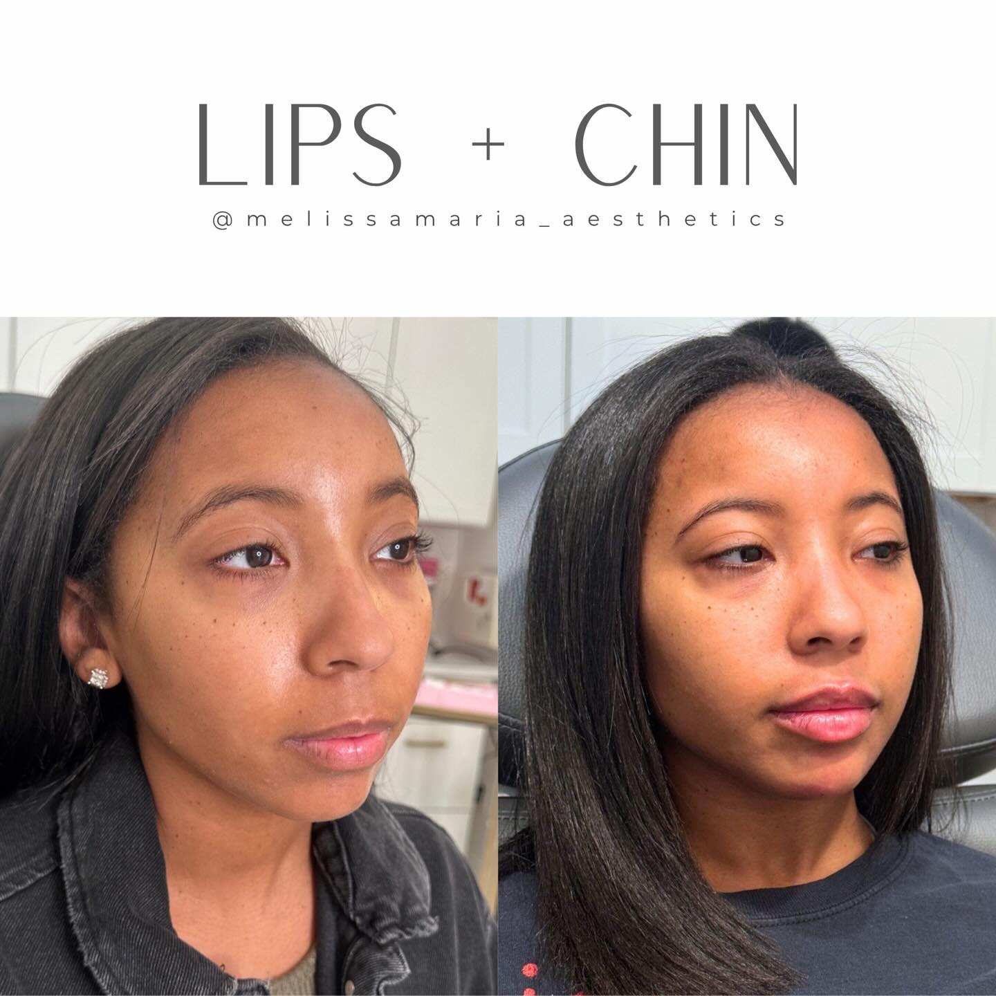 This beauty came to me a few years ago wanting just lips. On assessment we agreed that her lower face was off balance, and in order to start on a balanced canvas we would need to add a little chin. We opted for chin first and waited on the lips. She came in ready to do the lips this year, and even though she had some chin filler still left, We added a little more to ensure that when we added to her lips, she would remain balanced, and this is the final result!
let me know your thoughts in the comments 👇🏽
#lipsbymeli #lipfillerraleigh #chinfillerraleigh
