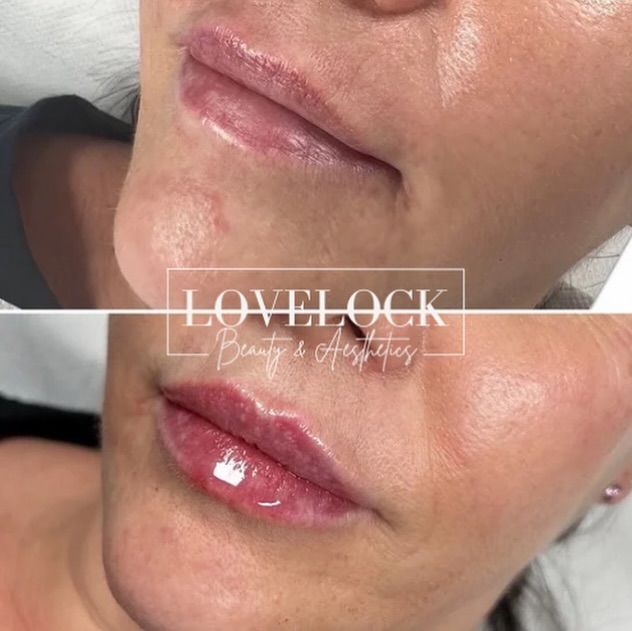 No overfilling, no “fake” look just hydrated, plump, and perfectly you 💋
Treatment benefits:
• Subtle volume and definition
• Improved lip symmetry
• Smooths fine lines
• Long-lasting hydration
Every treatment is tailored to suit your face and your goals, because natural results will always be in style.
#warminster #westbury #melksham #frome #devizes