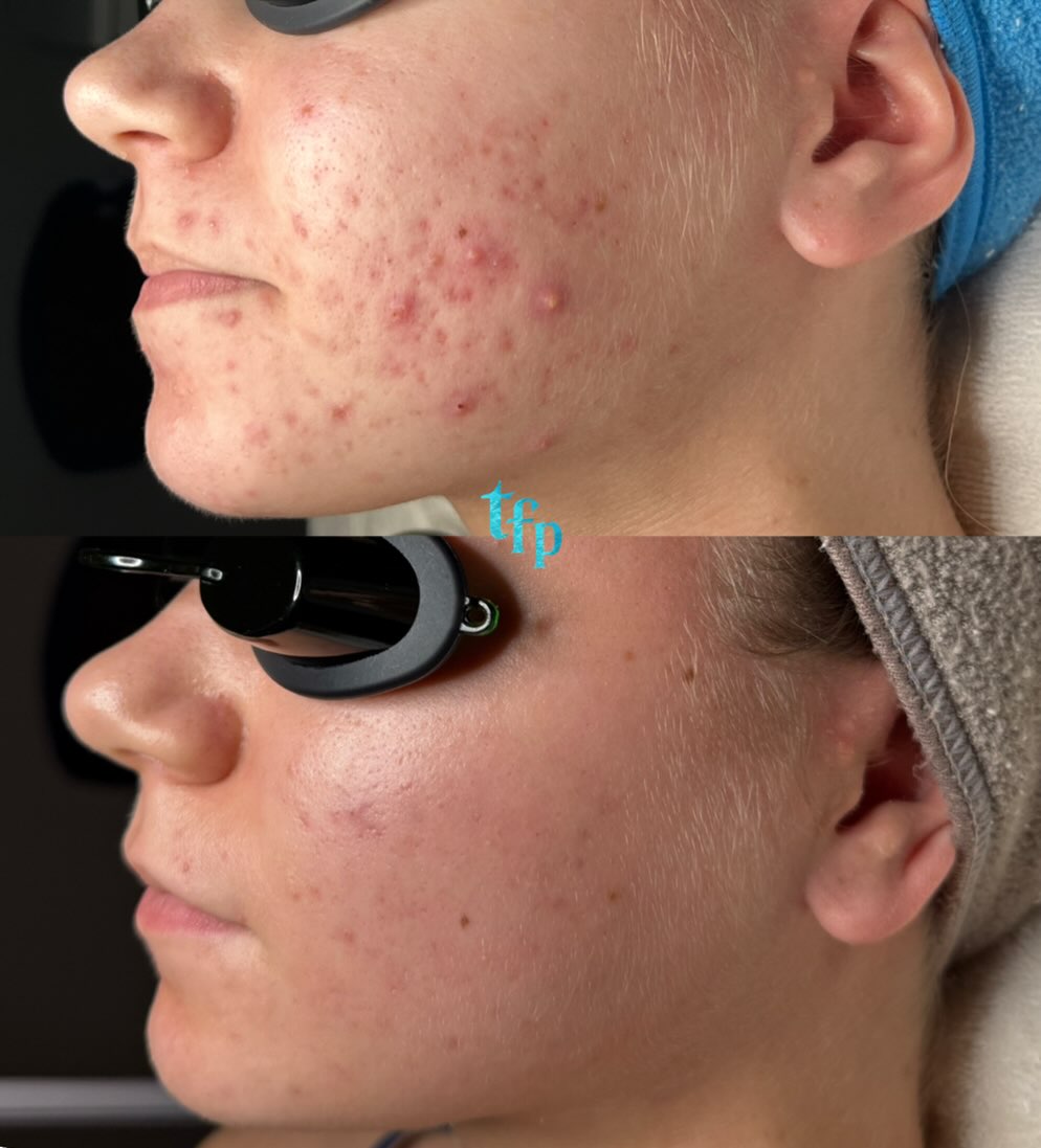 Clearing your acne naturally is possible with my biweekly Acne Bootcamp program. You can get clear skin in 3-5 months 🩵
How it works:
🪼Come in biweekly for acne facials (discounted to $109)
🪼Purchase a full customized skincare routine with me and do it morning and night at home (around $300 give or take)
🪼Switch to acne-safe makeup and laundry detergent
🪼Minimize acne triggering foods in your diet
Let’s get you clear once and for all! Book on thefaceplacemi.com ! I can’t wait to help you🌊🫶🏼