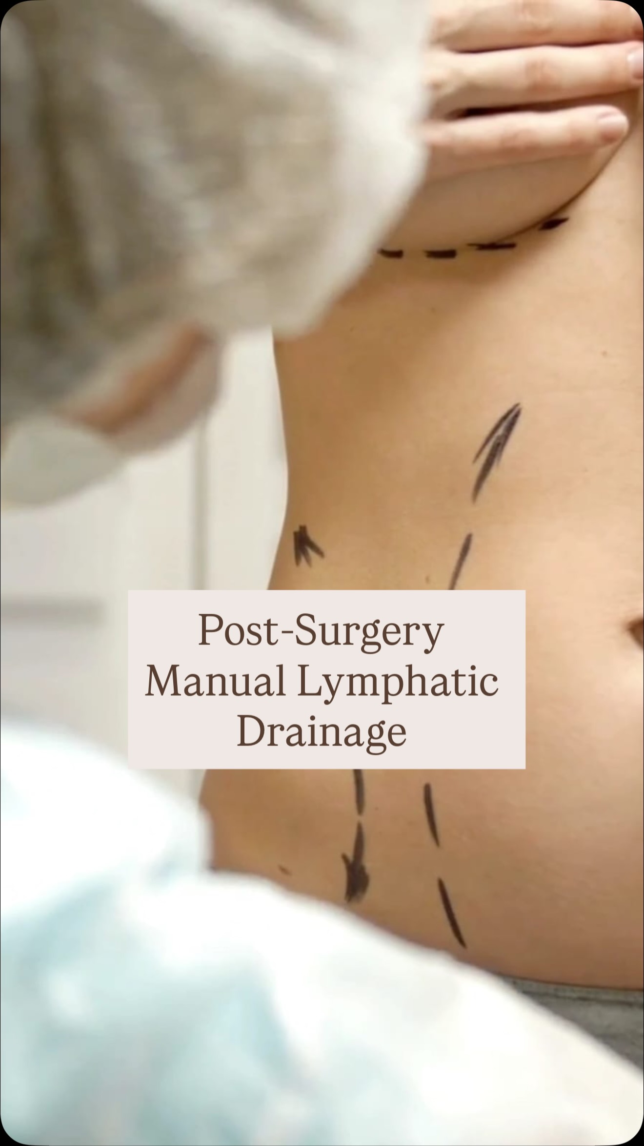 ✨ Post-Surgery Manual Lymphatic Drainage ✨
Boost Healing | Reduce Complications | Speed Up Recovery
Recovering from surgery can be challenging, but Manual Lymphatic Drainage (MLD) is a gentle and highly effective therapy that supports your body’s natural healing process. It is especially beneficial following both cosmetic and oncology surgeries, when performed by a qualified and experienced therapist.
🌿 Key Benefits
✅ Reduces Swelling and Fluid Retention
MLD stimulates the lymphatic system, helping to move excess fluid away from the surgical area and significantly decreasing post-operative swelling.
✅ Helps Prevent and Manage Complications
Regular sessions can reduce the risk of:
Seroma (fluid accumulation)
Fibrosis (hardened or thickened tissue)
Excessive bruising
Delayed wound healing
Lymphedema, particularly after lymph node removal
Infection risk
✅ Speeds Up Recovery
By enhancing circulation and supporting the immune system, MLD accelerates tissue repair and helps patients return to daily activities more comfortably.
✅ Minimises Pain and Discomfort
The gentle, rhythmic techniques calm the nervous system, reducing pain and promoting deep relaxation.
✅ Improves Scar Healing
MLD supports healthy scar formation and, when combined with scar therapy, enhances tissue flexibility and appearance.
✅ Enhances Surgical Outcomes
By reducing swelling and preventing fibrosis, MLD helps achieve smoother and more comfortable long-term results.
🌸 Ideal After Procedures Such As:
Cosmetic Surgeries
Liposuction
Tummy tuck (abdominoplasty)
Breast augmentation or reduction
Facelift and other cosmetic surgeries
C-section
Orthopaedic surgeries
Oncology Surgeries:
Mastectomy or lumpectomy
Lymph node removal or biopsy
Breast reconstruction
Gynaecological cancer surgeries
Head and neck cancer surgeries
Melanoma-related lymph node dissections
#ManualLymphaticDrainage #PostSurgeryRecovery #OncologyMassage #LymphoedemaCare #scartherapy