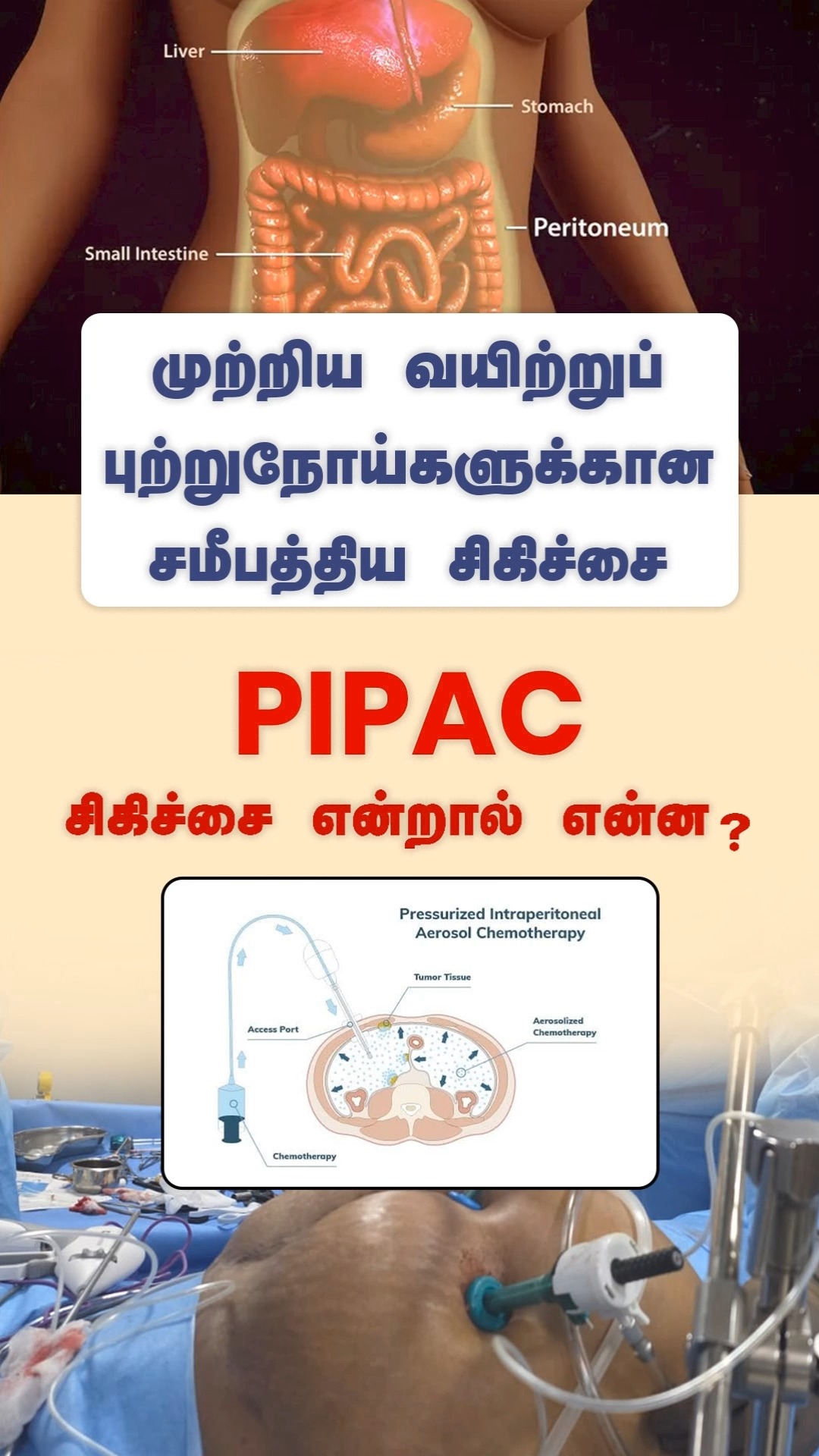 முற்றிய வயிற்றுப் புற்றுநோய்களுக்கான சமீபத்திய சிகிச்சை
PIPAC சிகிச்சை என்றால் என்ன?
.
.
.
PIPAC(PressurizedIntra‑PeritonealAerosolChemotherapy)
Peritoneal metastases / peritoneal surface malignancies
Intraperitoneal chemotherapy / locoregional chemotherapy
Aerosol chemotherapy, pressurized chemotherapy
Peritoneal carcinomatosis
Laparoscopic chemotherapy / minimally invasive intraperitoneal therapy
#drvimalathithan
#pipac
#chennai
#gleneagleshospital