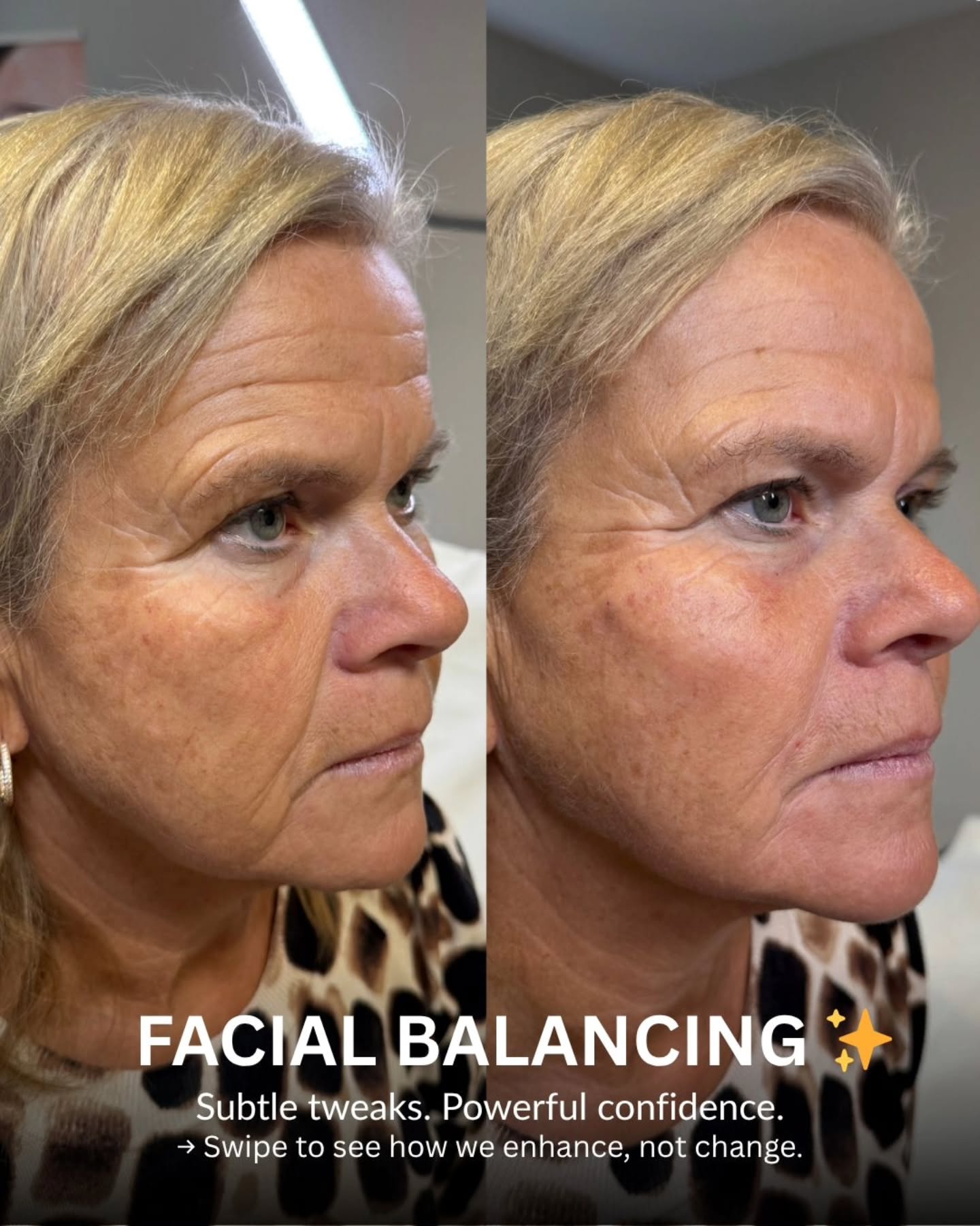 🔥🤍 FACIAL BALANCING, NOT FACIAL CHANGING 🤍🔥
Subtle, strategic tweaks can make the biggest difference.
This isn’t about adding volume everywhere — it’s about placing it where your face truly needs support.
As we age, it’s not just lines… it’s volume loss, shifting structure, and imbalance.
That’s why treating the face as a whole creates results that look natural, lifted, and refreshed — never “done.”
Think:
• Restored cheek structure
• Softer heaviness around the mouth
• Brighter, more awake eyes
The goal?
You… just more refreshed, more confident, and more balanced.
Ready to feel like yourself again?
DM “balance” to start your journey or book your consultation today.
#facialbalancing #naturalaesthetics #dermalfillers #aestheticswarrington #warringtonaesthetics