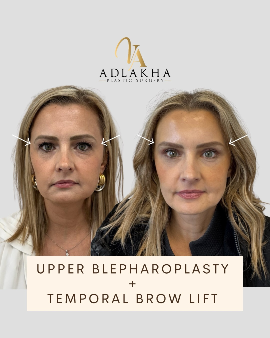 📏 Surgery of the upper face is measured in millimeters, and even millimeters of skin can globally optimize the face, giving it a more lifted, refreshed, and youthful appearance.
🔎 Procedures such as a temporal brow lift and upper blepharoplasty (eyelid lift) focus on subtle repositioning rather than large changes, with the goal of restoring natural contour and expression.
⏳ Most patients experience mild to moderate swelling and bruising in the first 7–10 days, with a return to light activities within about a week.
🪡 Incisions are designed to heal discreetly, and results continue to refine over several weeks as swelling resolves.
To book your complimentary consultation you can:
📞Call 234 458 2010
📲DM @dr.vidhiadlakha
📧Email us info@adlakhaplasticsurgery.com
💻Visit the website in bio
This is an actual patient of Dr. Vidhi Adlakha. All photos are released with consent. Please do not use or distribute without permission.
#blepharoplasty #browlift #eyelidlift #hoodedeyes #antiaging