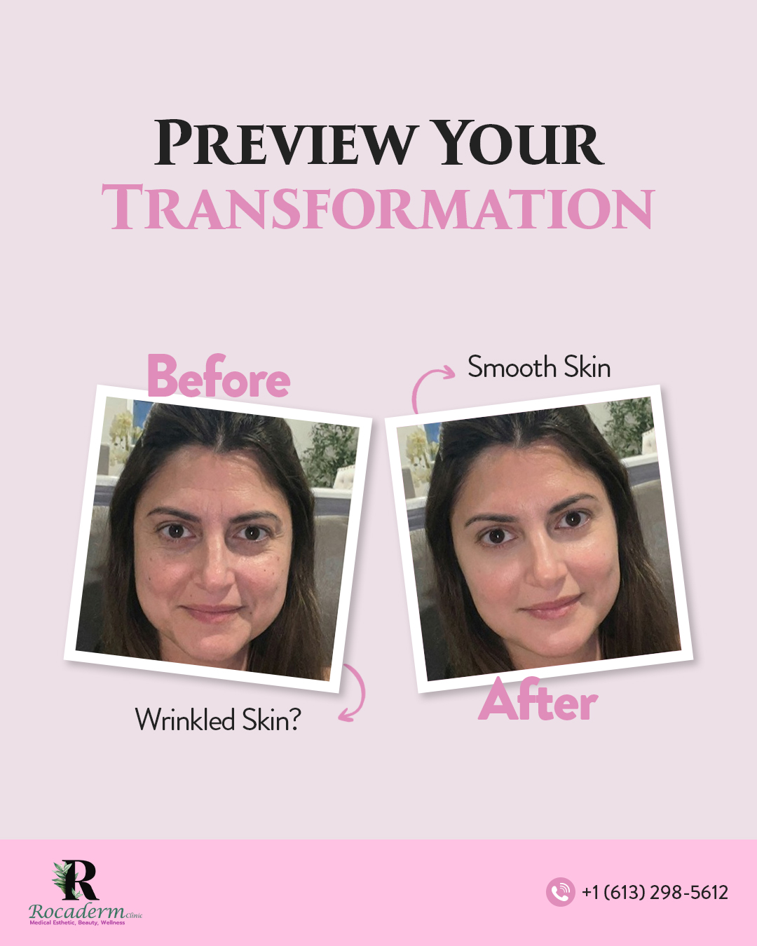 See it before you believe it. 👀✨
Snap → Upload → Transform.
Preview your post-treatment results in seconds with Rocaderm Clinic.
Link: https://www.ageless.ai/en-US/a/rocadermclinic/transformation/pre-scan
📞 +1 (613) 298-5612
Book your preview at Rocaderm Clinic today!
#RocadermClinic #GlowUp #SkinTransformation #OttawaBeauty