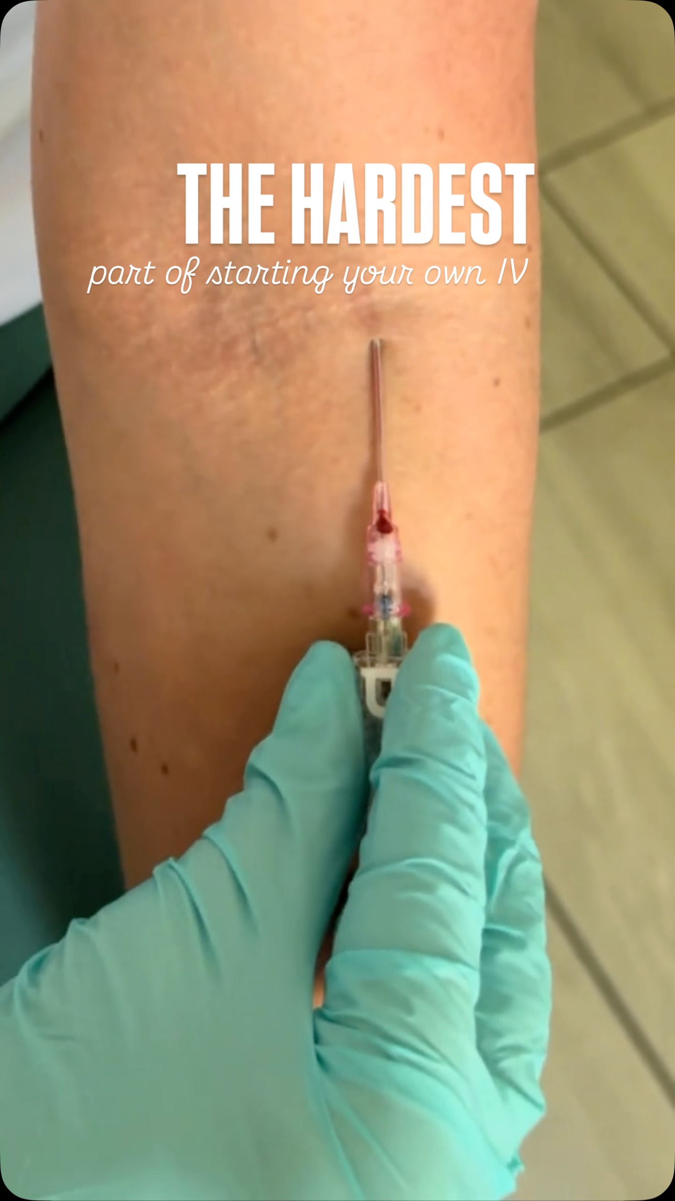 Starting your own IV is one thing… but trying to screw the line in one-handed without losing it? That’s a whole different skill 😂
If you’ve ever struggled with this part, you’re not alone — here’s how to make it easier 👆🏻
#ivstarts #nurselife #nursesofınstagram #ivtherapy #nurseproblems