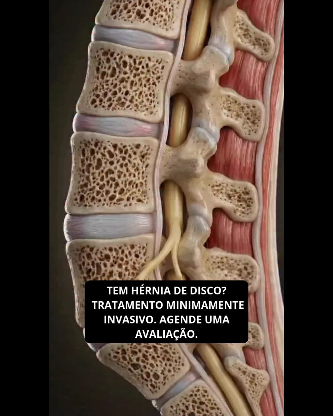Tem hérnia de disco e acha que acabou? ❌
A verdade é que a maioria dos casos tem tratamento — e você não precisa conviver com dor todos os dias.
Dor na lombar, que irradia para a perna, formigamento ou travamento?
Isso é o seu corpo pedindo atenção.
Quanto antes você trata, maiores são as chances de recuperar seus movimentos e voltar a viver sem limitações.
👉 Não normalize a dor. Existe solução.
💬 Comente “DOR” que te explico os próximos passos.
#HérniaDeDisco #DorLombar #Ciático #ColunaVertebral #SemDor #QualidadeDeVida #ReelsSaúde #SaúdeDaColuna #ProjetosSemDor