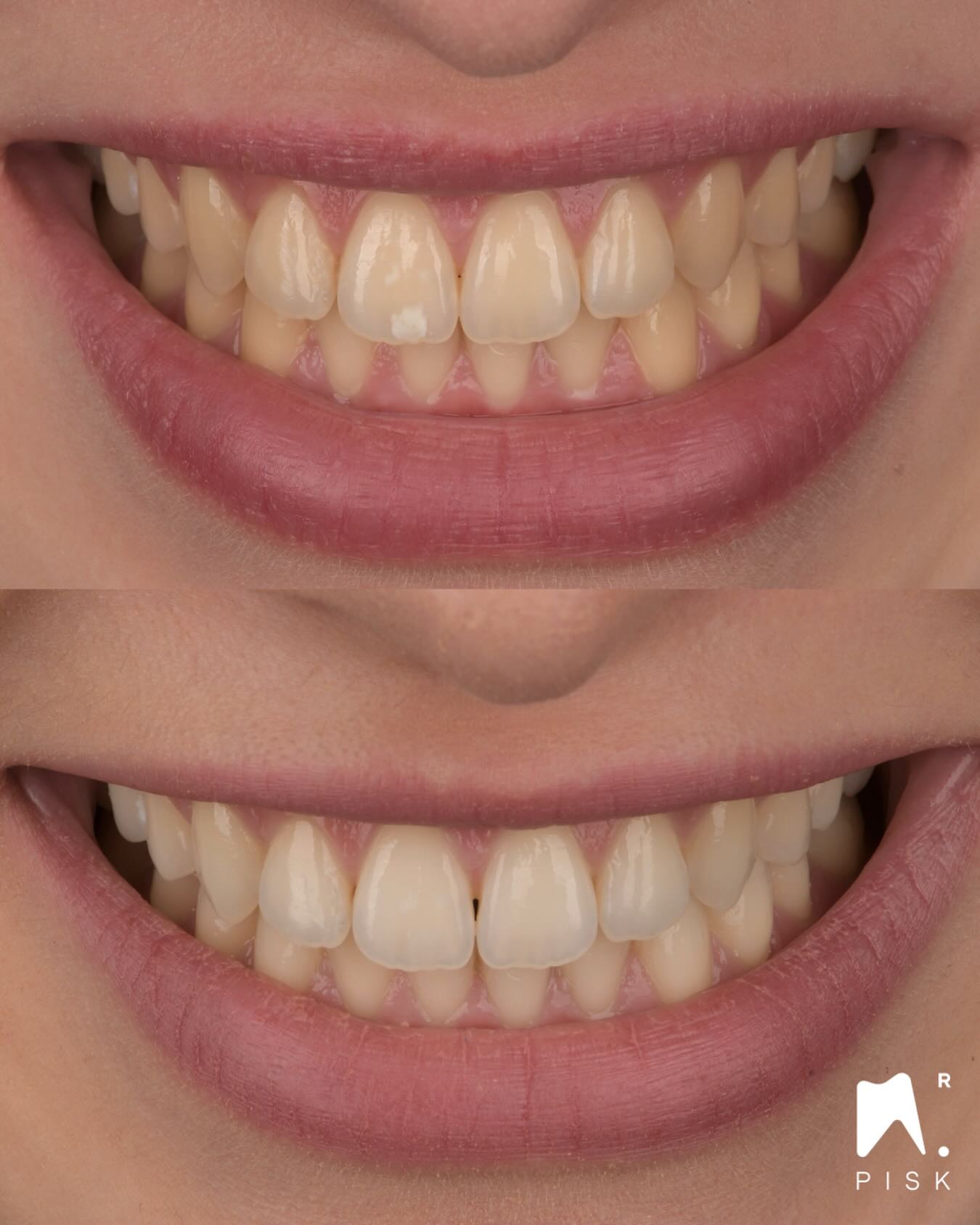 After healing of gingivitis, Bleaching & ICON ❤️