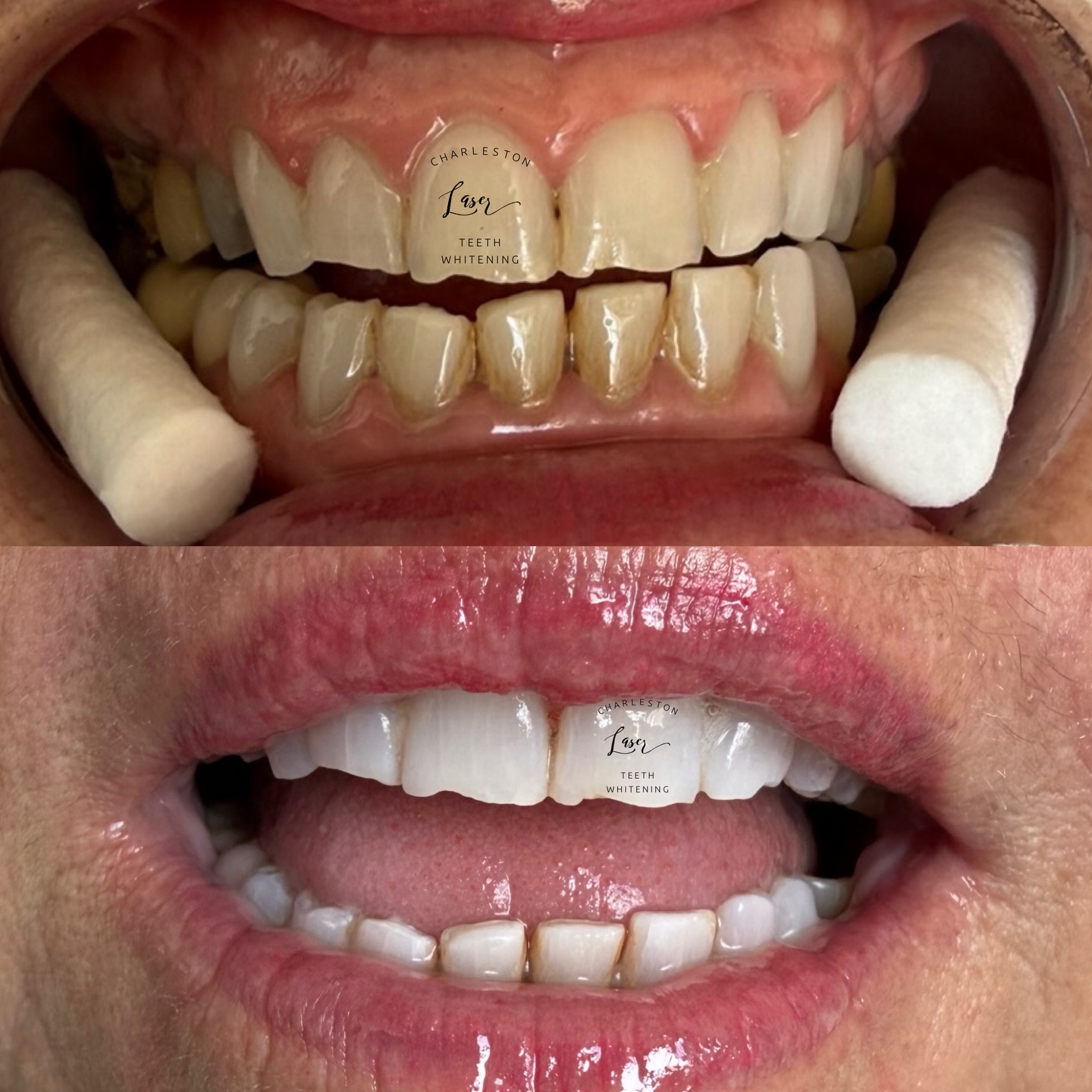 That instant pick me up...💁♀️✨🦷👌
Book Your Teeth Whitening Now!
www.CharlestonLaserTeethWhitening.com
#teethwhitening #charlestonteethwhitening #charleston #charlestonsc #charlestonlaserteethwhitening mountpleasant mountpleasantsc kiawahisland kiawahjamesisland westashley isleofpalms downtowncharleston sullivansisland johnsisland johnsisland northcharleston northcharlestonsc folly follybeach laserteethwhitening