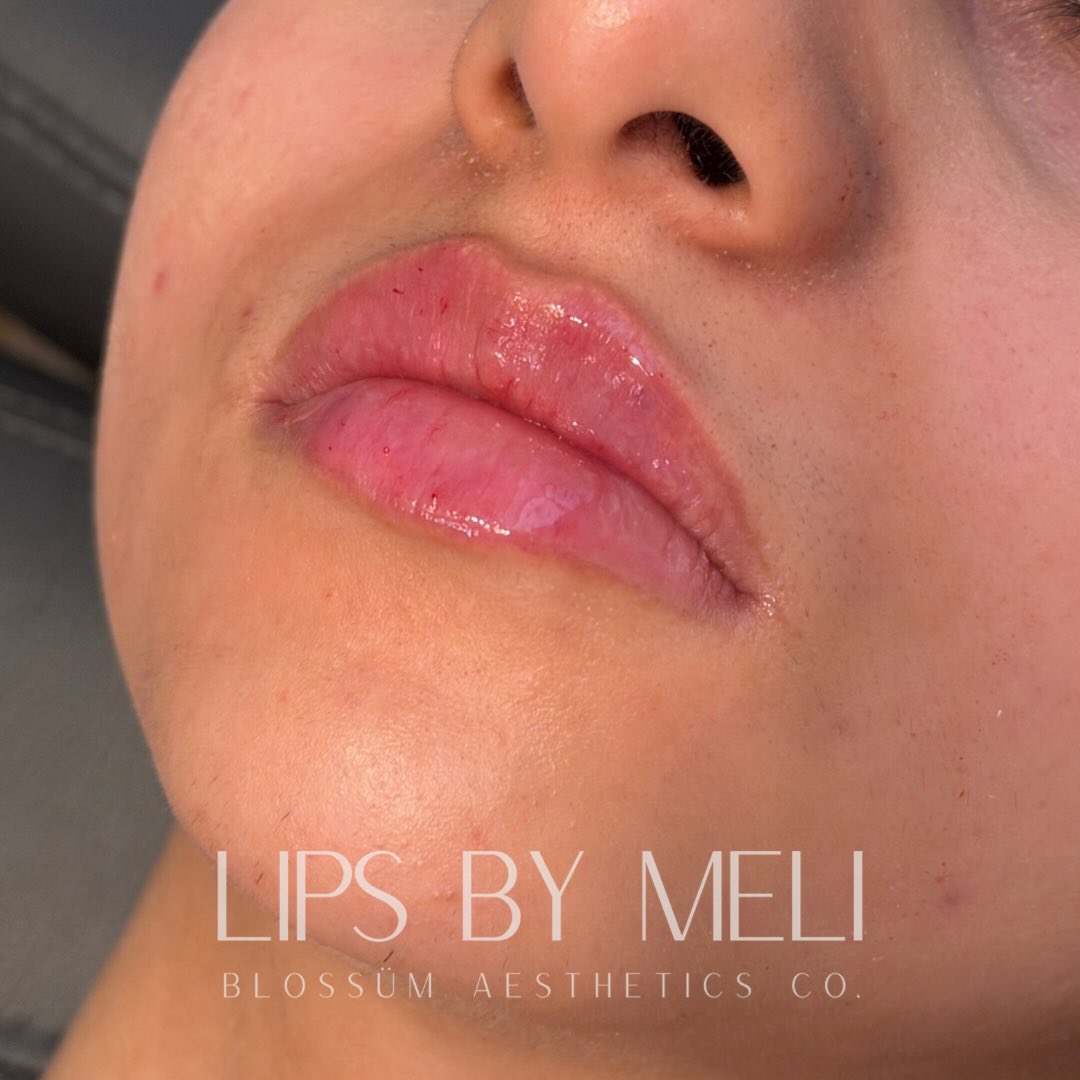 Why our lips look different….
1. Because we don’t charge per amount.
We do what the tissue allows.
That’s also why we don’t have issues with migration.
2. We also don’t limit you to one specific product.
We do whatever your tissue needs and your tissue can vary from to bottom or from middle to lateral.
3. Because we educate and our patients trust us enough to allow us to be the experts.