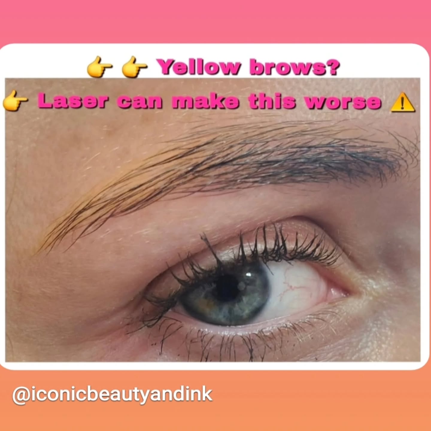 If youโre trying to remove botched browsโฆ laser is not always the best option โ ๏ธ
๐ฉท This client came to me after trying to remove her previous PMU with laser... and her brows healed yellow.
This is something many people arenโt warned about.
Laser removal does not treat all pigment colors equally.
It targets certain tones, which can lead to unpredictable color changes like:
Yellow
Orange
Red
Because laser breaks down pigment based on how it absorbs energy โ and not all pigments respond the same way.
โจ Saline removal (LI-FT) works differently.
Instead of using heat, it helps lift pigment out of the skin, making it:
โ๏ธ Safe for all pigment colors
โ๏ธ More controlled
โ๏ธ Ideal for correction cases
I specialize in brow correction + saline tattoo removal โ especially for clients dealing with unwanted color changes or previous work that didnโt heal properly.
#browcorrection
#salinetattooremoval
#pmuremoval
#fortlauderdalebrows
#fixmybrows