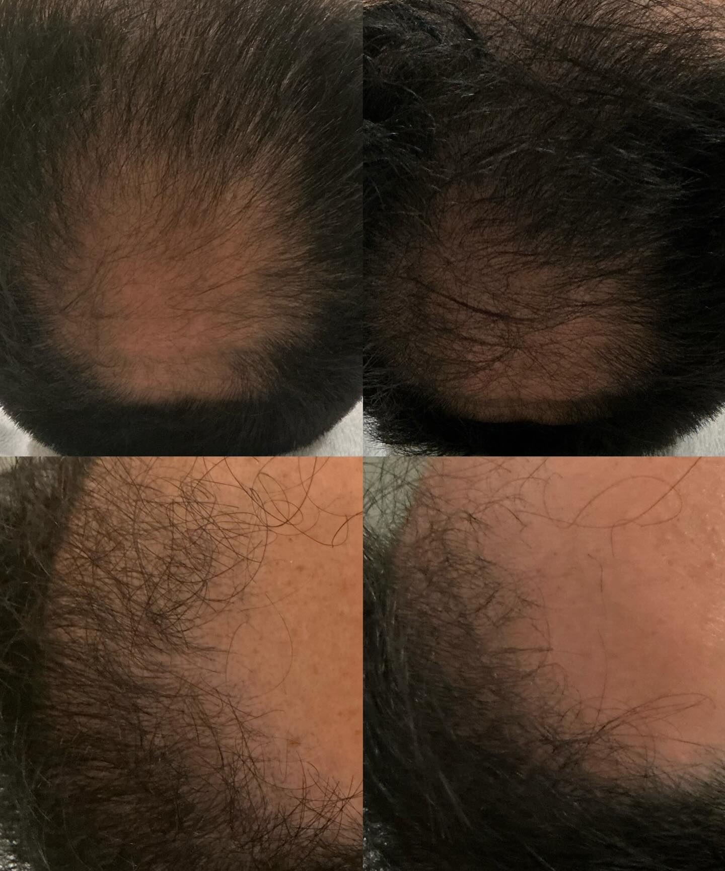 Stronger, healthier hair starts at the scalp ✨
Our Fotona Hair Restart treatment uses advanced laser technology to stimulate blood circulation, awaken dormant follicles, and improve scalp health—creating the ideal environment for hair growth.
This is not an overnight fix, but with consistency, you’ll see thicker, fuller, and healthier hair over time. 💫
#fotonalaser #hairgrowth #laserhairgrowth #medicalspa #hairregrowth
