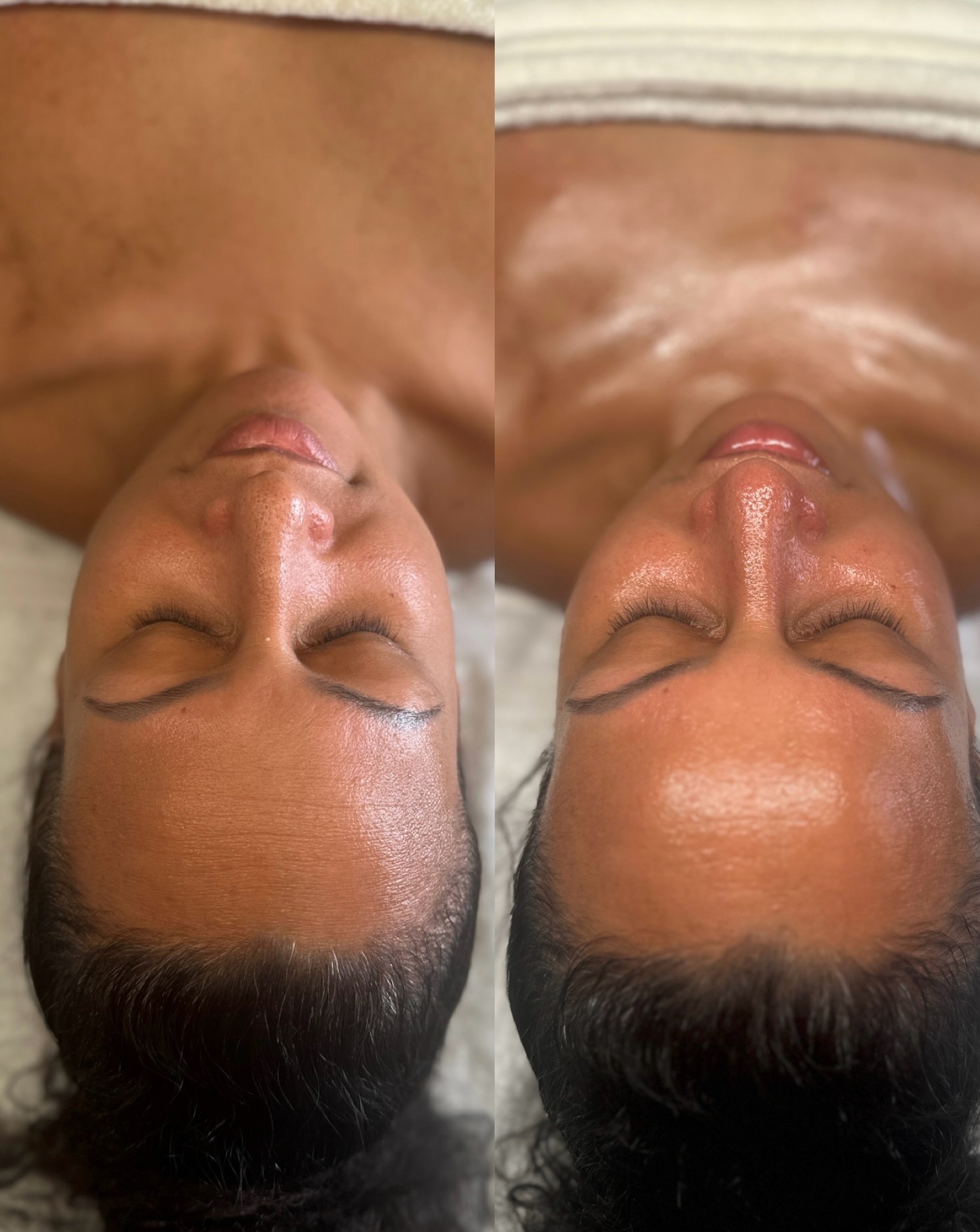 Here’s your reminder that just because your skin looks good… it doesn’t mean it should be ignored 🙌
Healthy, glowing skin isn’t just about what you see today, it’s about what you’re protecting for tomorrow.
Even if you’re not dealing with breakouts, pigmentation or visible concerns, your skin is still constantly changing. Supporting proper cell turnover, maintaining hydration, and protecting against environmental damage are all essential if you want to keep that glow long-term ✨
Prevention will always be better than cure. The small, consistent steps you take now can delay signs of ageing, preserve your skin quality, and keep everything functioning exactly as it should.
Because yes… your skin might already look great…
But wouldn’t you want it to look amazing for years to come? 😍
Invest in your skin now, and your future self will thank you.
Let’s keep you looking like the best version of you! always! 💫
#skinclinictalbotgreen #skincarespecialiatpontyclun #acnespecialist #healthyskintreatment #facialistaouthwales
Cardiff
Cardiffbloggers
Anti-aging treatment