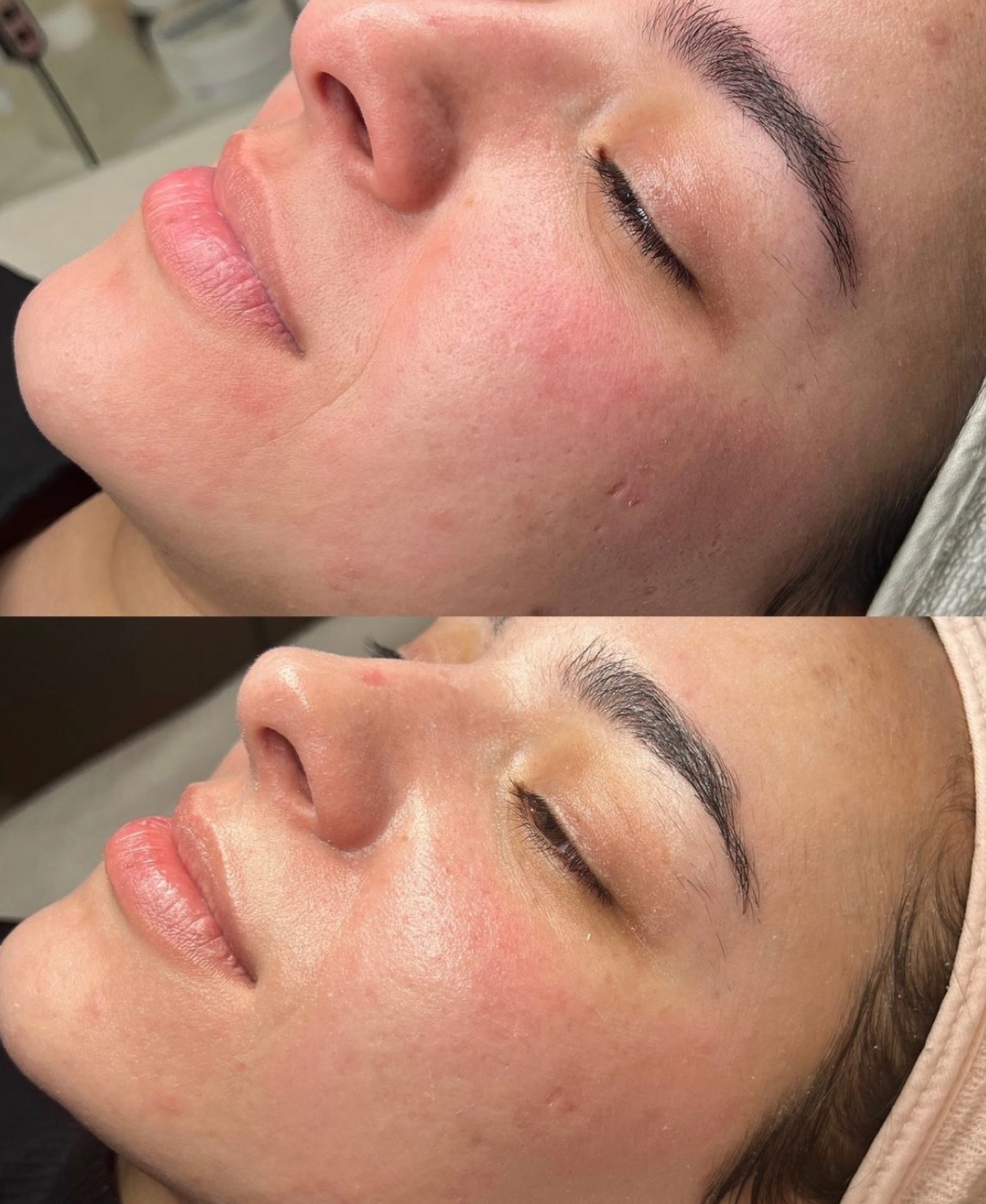 ✨ Microneedling: Your Skin’s Natural Glow-Up ✨
Looking for a treatment that helps your skin look smoother, firmer, and more radiant? Microneedling might be exactly what you need! 💆♀️
🔍 What is Microneedling?
Microneedling is a minimally invasive skin treatment that uses tiny, sterile needles to create micro-injuries in the skin. This process stimulates your body’s natural healing response, boosting collagen and elastin production.
💡 Benefits:
✔️ Improves skin texture and tone
✔️ Reduces fine lines and wrinkles
✔️ Minimizes acne scars and pores
✔️ Enhances product absorption
✔️ Gives your skin a natural, healthy glow
⏳ What to expect?
After the treatment, your skin may appear slightly red (like a mild sunburn) for 24–48 hours. Over the next few days, your skin will start to feel smoother and look more refreshed.
💖 Best results?
A series of sessions is recommended for optimal, long-lasting results. Your skin will thank you!
📩 Ready to transform your skin? Book your appointment today!
#Microneedling #SkinCare #GlowSkin #CollagenBoost #beautytreatments