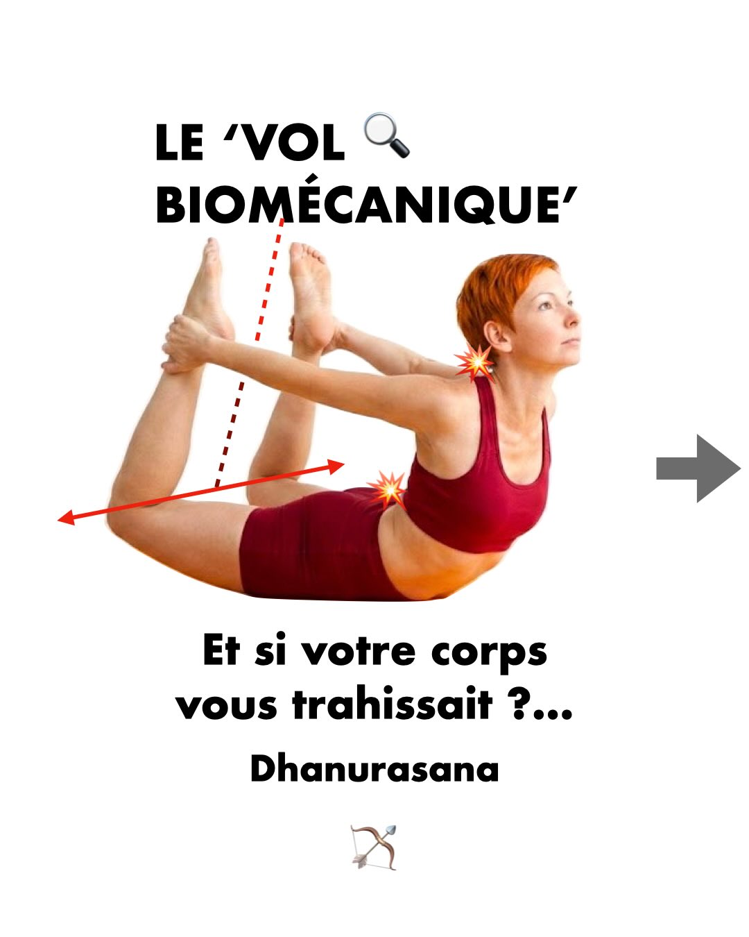 Et si votre corps vous trahissait ? 🔍
Dans Dhanurasana (l’arc), l’élan est souvent magnifique.
Mais pour monter plus haut, la mécanique corporelle cherche parfois une « issue de secours ».
Une consigne circule souvent : « Écartez les genoux pour aller plus loin ».
C’est une erreur de mécanique de base.
🔴 Le mécanisme :
Si le Droit Fémoral (quadriceps) est raide, il verrouille la hanche. En écartant les genoux, on contourne l’obstacle au lieu de le franchir.
🔴 La conséquence : La charge glisse sur vos vertèbres lombaires et votre nuque se « casse ». La posture n’est plus un espace d’ouverture, elle devient une zone de tension. 📉💥
L’approche en Yogathérapie posturale : la discipline du préparatoire. 💎🌿
On ne s’improvise pas dans l’Arc.
Il faut s’astreindre à un travail de fond :
✅ Étirer pour libérer le verrou de la hanche.
✅ Tonifier pour que le muscle soutienne la structure.
C’est dans ce travail invisible que l’on construit la liberté de demain. 🛠️✨
On ne cherche plus à « faire » la posture, on la découvre et on la laisse agir en nous. 🙏🏛️
Et vous ? Prenez-vous le temps de préparer vos quadriceps avant les extensions ?
On en discute avec cœur en commentaire ! 👇
#Yogatherapie #dhanurasana #pont #AnatomieYoga #cathetsergeyoga
