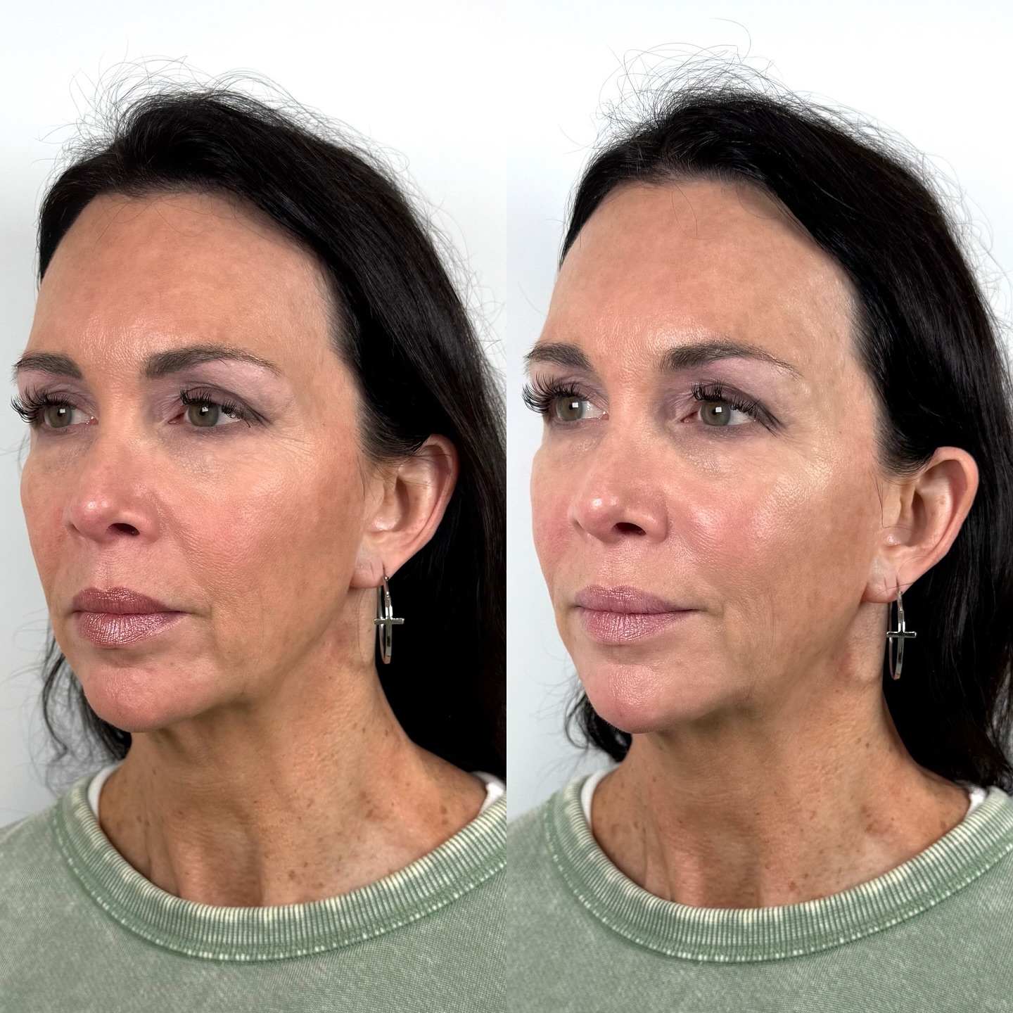 People often think facial balancing is just about knowing anatomy.
And yes—understanding facial anatomy is essential. But the real artistry lies in seeing beyond the map… having the eye to recognize where harmony is missing, what needs support, and how to place product in a way that creates balance and more seamless transitions without ever looking obvious.
This beautiful patient is a longtime friend, my trainer, and someone who truly embodies what aging well looks like. She helps keep me fit, and I help keep her facial structure supported in a way that honors her natural beauty. At 62, she is proof that caring for your body, mind, and skin as a whole translates into graceful, lasting results.
This visit was her facial balancing maintenance appointment—using very minimal product, we subtly refreshed her temples, added light midface support, softened the pyriform area, nasolabial folds and marionette lines, and refined the chin and chin shadow. Small, strategic adjustments can make the most beautiful difference when placed with intention.
Facial balancing is never about changing how you look—it’s about restoring proportion, structure, and harmony in a way that still feels completely like you.
Curious what facial balancing could do for you? DM us “BALANCE” for details, or call/text us to schedule your consultation.
#FacialBalancing #FullFaceRejuvenation #NaturalAestheticResults #FacialHarmony #DFWAesthetics #ArgyleMedSpa #AgingGracefully #FACAesthetics