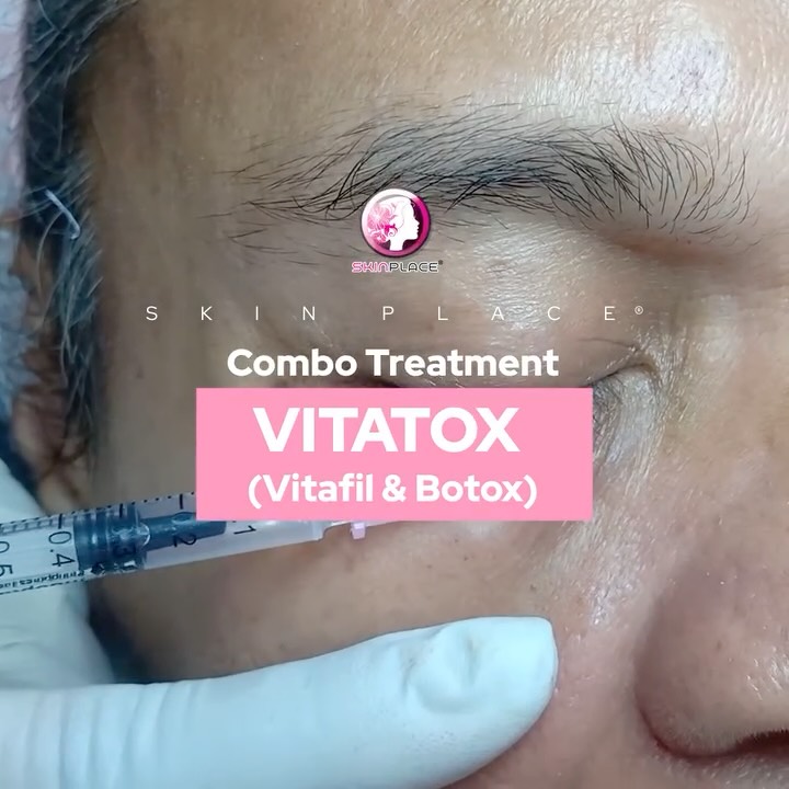 Refresh and revive your glow with the Skin Place Combo Treatment! Featuring our signature VITATOX Eye Focus Treatment 💉💖.
This curated duo is designed to:
Smooth the appearance of fine lines.
Deeply hydrate the delicate under-eye area.
Brighten and refresh for a well-rested look.
Experience a radiant, youthful-looking lift without the need for surgery. Perfect for a quick glow-up with minimal downtime! 🌟
Skin Place is Your Skin’s Place.
✨ See the comment section below for more details! ✨
#SkinPlace #VITATOX #EyeFocusTreatment #SkinPlaceGlow #YouthfulEyes #SkincareGoals #RadiantSkin