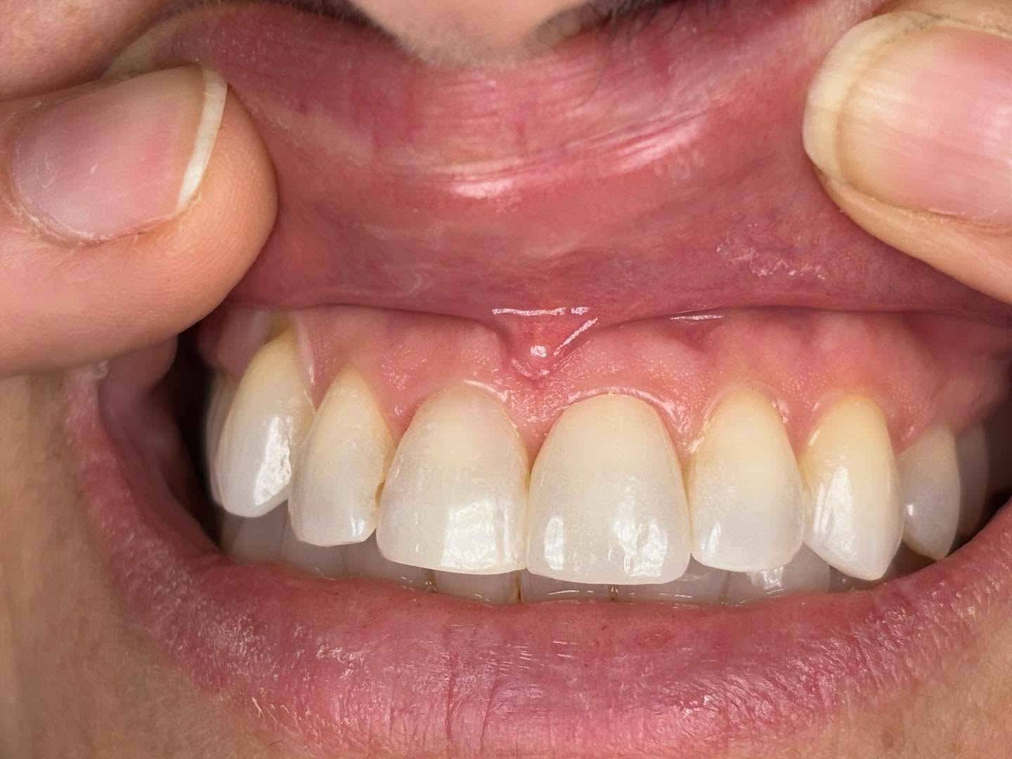 In-house Custom Shade Taking here at Precision Esthetics Dental Laboratory is one of our specialties. Our Master Ceramist notes the shade of the stump and that of the teeth adjacent to the reconstruction. The Zirconia is then layered and mimetized into a smile where… could you guess which tooth was unlike the rest?
Request more info about our Shade Matching Services.
561.805.7750