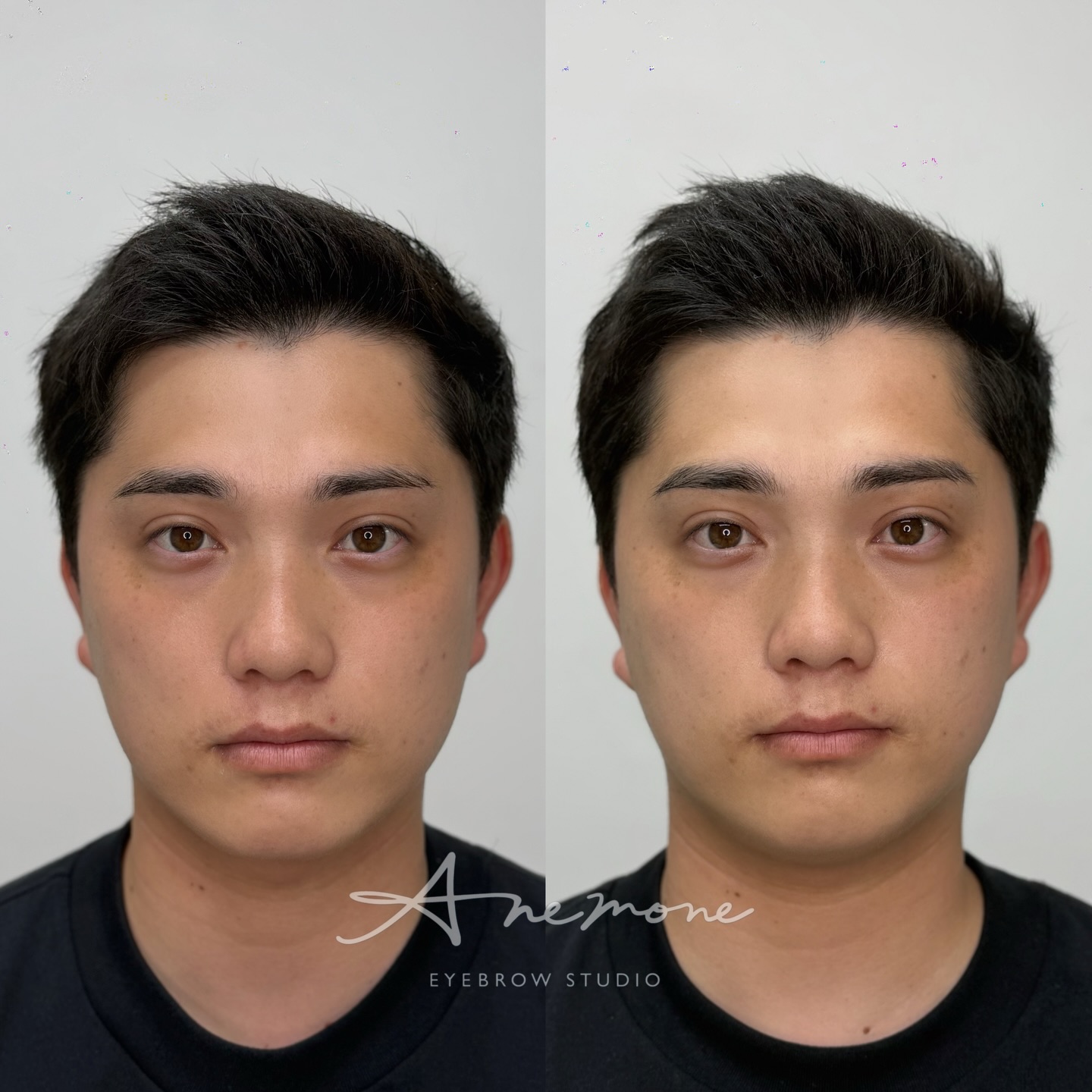 少しの変化でお顔が変わる✨
眉毛って本当に奥深いですね。
■Hair stroke for men
■Price
First session 10,000B
Second session 6,000B
■🙅♀️Please avoid sweating and exercise for one week
■The required time
1.5h
■Reservation
OfficiaLINE @anemonebk