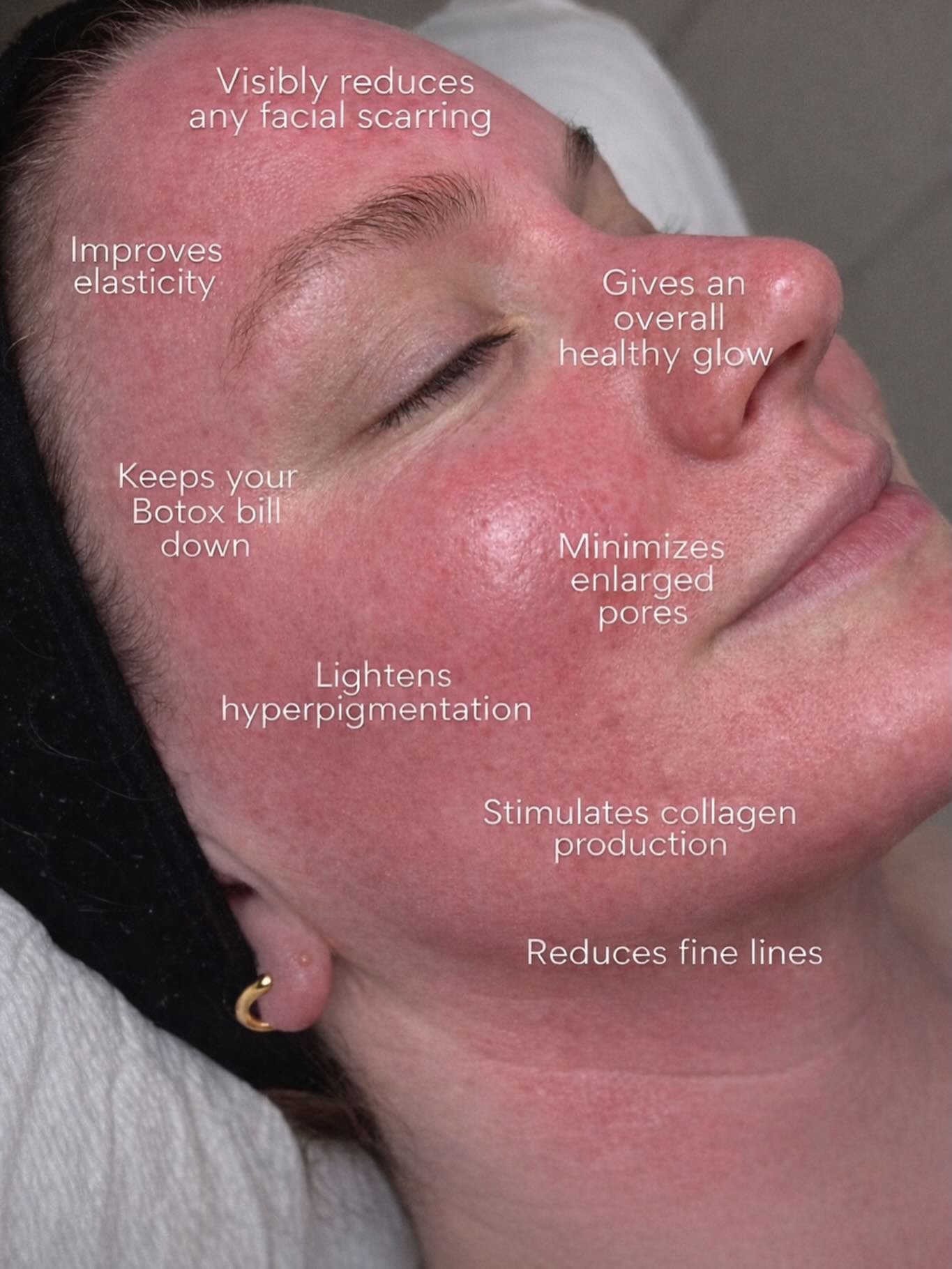 ✨ SKIN REJUVENATION STARTS HERE ✨
At Slay Aesthetics, we believe confidence begins with healthy, glowing skin.
Microneedling is one of our favorite treatments to naturally stimulate collagen production, improve texture, soften fine lines, and restore that fresh, radiant glow your skin deserves.
Minimal downtime. Maximum glow. Real results.
Ready to elevate your skin? Let’s slay your skincare goals together. 💉FINANCING AVAILABLE THROUGH CHERRY
📍Book your appointment today
#SlayAesthetics #Microneedling #GlowFromWithin #SkinRejuvenation #CollagenBoost