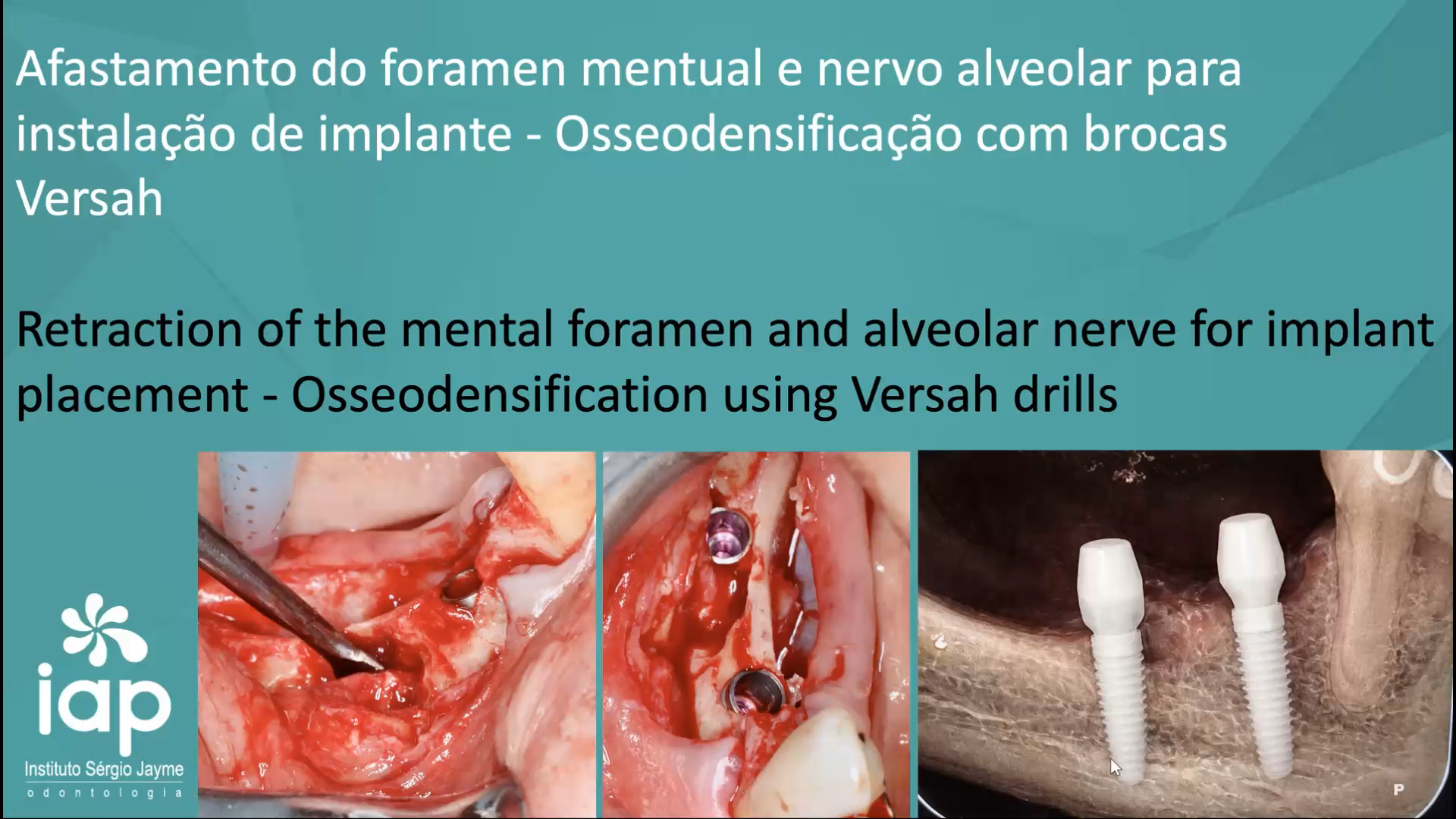 Afastamento do foramen mentual e nervo alveolar para instalação de implante -Osseodensificação com brocas Versah
Retraction of the mental foramen and alveolar nerve for implant placement - Osseodensification using Versah drills
A instalação de implantes na região posterior da mandíbula representa um dos maiores desafios da implantodontia, principalmente devido à presença do nervo alveolar inferior. Essa estrutura anatômica percorre o interior do canal mandibular e é responsável pela inervação sensitiva do lábio inferior, mento e dentes inferiores.
Nessa região, a altura óssea disponível frequentemente é limitada pela proximidade do nervo, o que reduz a margem de segurança para a instalação dos implantes. Qualquer erro no planejamento ou na execução pode resultar em complicações neurossensoriais, como parestesia, disestesia ou até anestesia permanente.
Além disso, a qualidade óssea posterior da mandíbula costuma ser inferior, com maior presença de osso medular, o que pode comprometer a estabilidade primária do implante. A reabsorção óssea após perdas dentárias agrava ainda mais esse cenário, aproximando o topo da crista óssea do canal mandibular.
Diante dessas limitações, o planejamento preciso com exames de imagem tridimensionais, como a tomografia computadorizada (CBCT), torna-se indispensável para avaliar a posição exata do canal mandibular e definir a melhor abordagem cirúrgica. Em muitos casos, pode ser necessário recorrer a técnicas avançadas, como implantes curtos, inclinação de implantes ou até lateralização do nervo alveolar inferior.
Portanto, o sucesso na reabilitação da região posterior mandibular depende de um profundo conhecimento anatômico, planejamento criterioso e execução técnica refinada, sempre priorizando a segurança do paciente e a preservação das estruturas nobres.
Obs: Cirurgia realizada no IAP Dr. Sérgio Jayme Av. Paulista, 91 Cj 402
Tel (11)5572-1283 / Cel e WhatsApp (11)94888-2000
CEP:01311-000 São Paulo-SP
Av. Rubem Berta, 1461 Tel (11)2276-2217 / Cel e WhatsApp (11)98383-3941
CEP: 04074-010 São Paulo-SP
#implante #periodontia #curso #rog #enxertoosseo #enxerto #iap #protesedental #protesedentaria #regeneracaoosseaguiada #carg