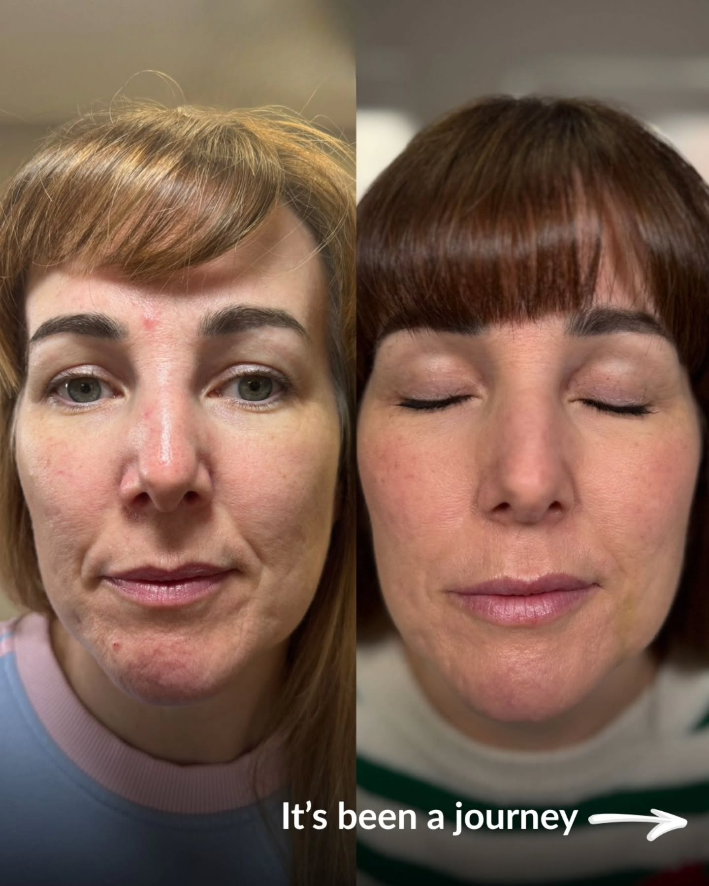 ✨ FROM ACNE SCARRING TO AISLE-READY GLOW ✨
This journey wasn’t about changing her… it was about refining, restoring, and revealing her natural beauty.
Over time, we focused on:
💧 Deep hydration
✨ Dmproved elasticity
🧬 Collagen stimulation
🌿 Smoothing texture + softening scars
With a combination of skin treatments and subtle enhancements, the result is skin that looks healthy, radiant, and effortlessly natural — just elevated.
Because the goal is never “overdone”… it’s confident, glowing, and comfortable in your own skin. 🤍
If you’re getting married 💍
Now is the time to start.
Great skin doesn’t happen overnight — it’s planned, nurtured, and built over time.
Your future self (and your wedding photos 📸) will thank you.
#bridalskinjourney #skintransformation #acnescars #aestheticswarrington #bridetobe