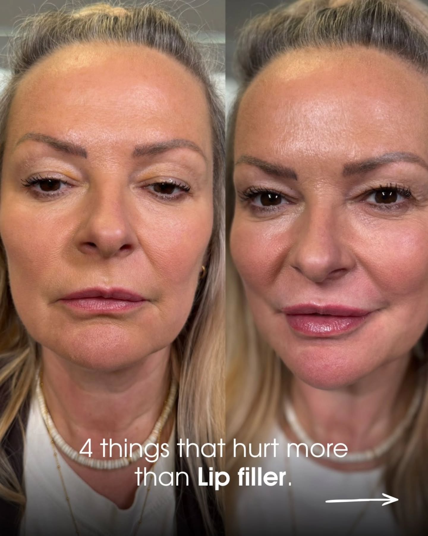 ✨ REAL TALK FROM YOUR PRACTITIONER ✨
I hear it all the time… “does lip filler hurt?”
Honestly? Not as much as you think. 😉
Dropping your phone on your face in bed? Worse.
Biting your tongue mid sentence? Definitely worse.
Checking your bank app after a shopping trip? Painful 😅
Removing waterproof mascara? Say less…
As your practitioner, my goal is always comfort, precision, and natural results you’ll love.
Numbing is used, technique matters, and I’ll guide you every step of the way.
So if you’ve been nervous… this is your sign. 💋
#lipfillerswarrington #aestheticswarrington #cosmeticinjector #naturallips #lipfillerscheshire