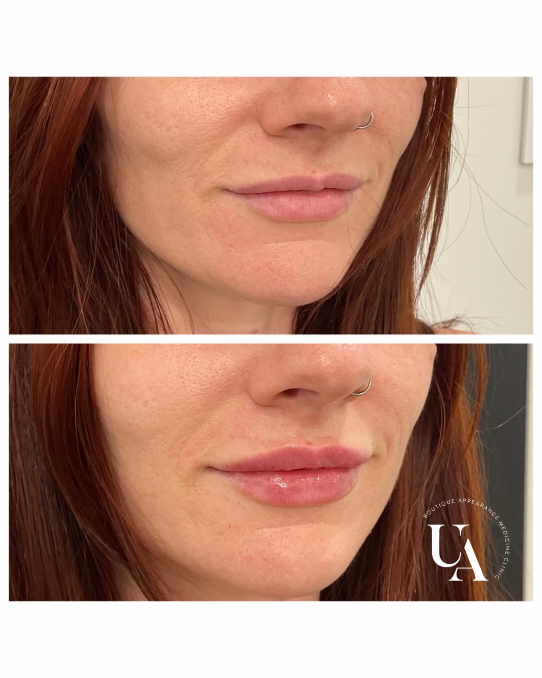So lovely catching up with this beauty❤️ wee tweaks to enhance her already beautiful lips😍
#lovemyjob #lipfillernz #lipenhancement #lipswellington #lipskapiti
Dermal filler injections are Medical devices for the treatment of loss of volume in the skin. Dermal fillers have risks and benefits. Ask your doctor if dermal filler injections are is right for you. For further information ask your doctor or go to www.medsafe.govt.nz