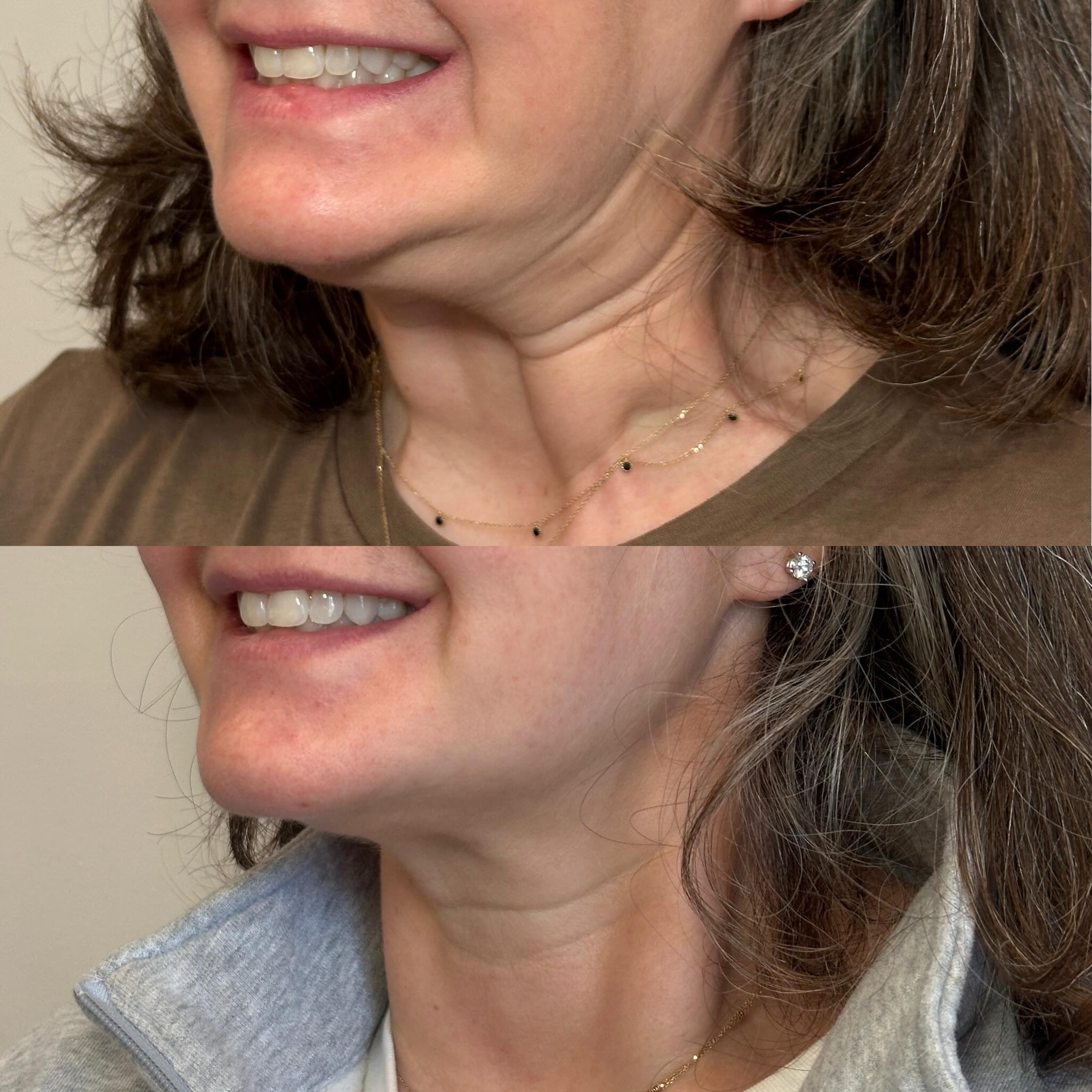 The Nefertiti Lift is a refined neurotoxin technique designed to redefine the jawline and lift the neck. By relaxing both parts of the platysma — the muscle that creates a downward drag on the lower face and a widening effect on the neck, we restore structure and softness where it matters most. Clean angles and fast, effortless results. ✨