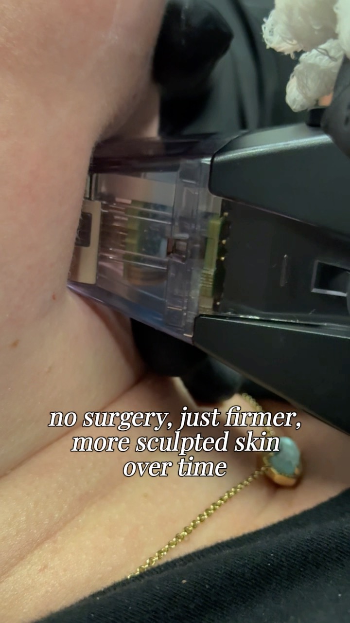 The treatment behind the lift ⚡️
Morpheus8 is not just microneedling. It combines it with radiofrequency energy to reach deeper layers of the skin and stimulate collagen production from within.
For areas like the neck, that means improving skin laxity, softening fine lines, and creating a smoother, more supported look over time. What really matters here is control.
Depth and energy are adjusted based on your goals. Tightening, refining, or subtle contouring. Every treatment is customized so the result looks natural and balanced.
No surgery. No drastic change. Just firmer, smoother skin that still looks like you.
📞 Call (318) 698-8711 to schedule your consultation
#Morpheus8 #SkinTightening #NeckRejuvenation #RFMicroneedling #DrKennethSanders