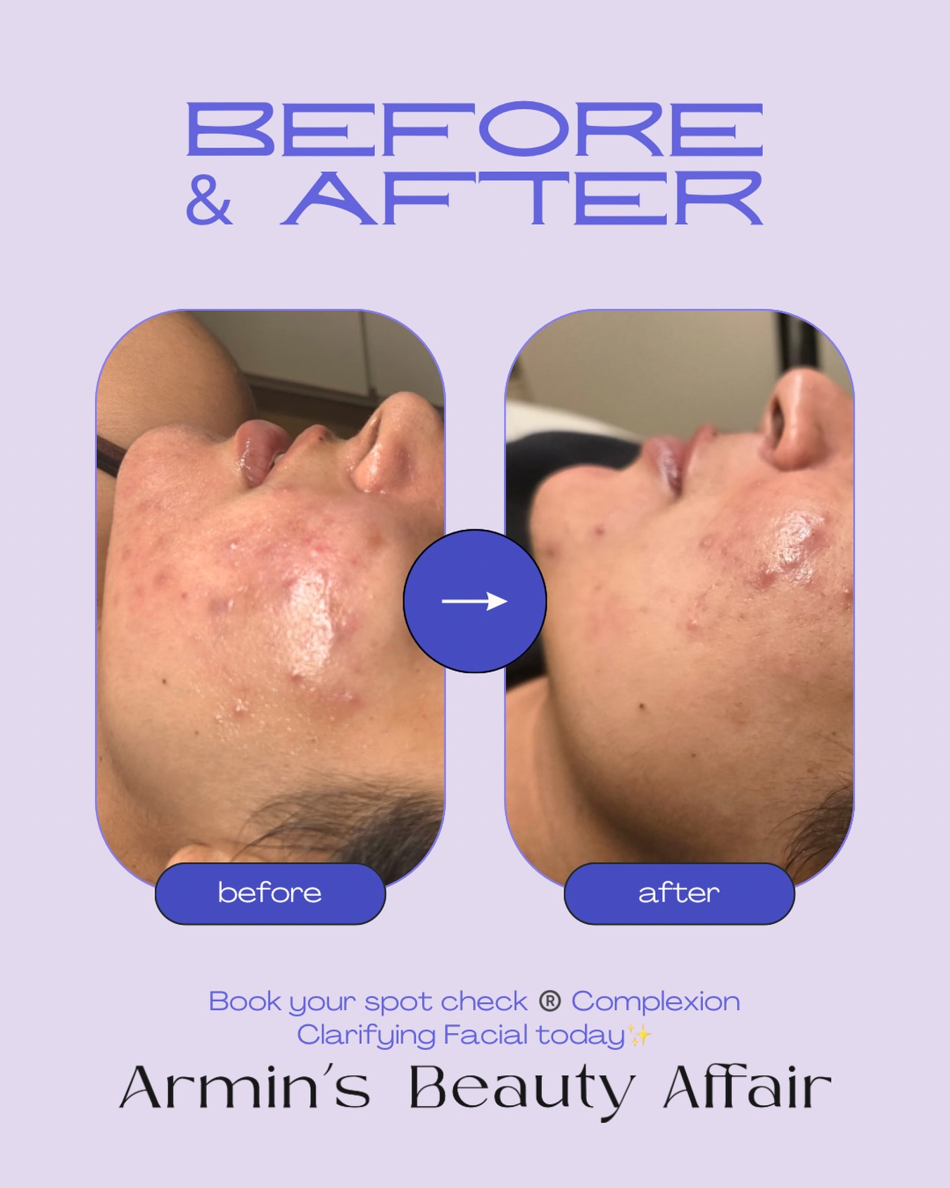 Say hello to clearer, smoother, glowier skin ✨
This is your go-to treatment if you’re dealing with breakouts, oily skin, or uneven texture—but don’t want anything harsh or drying. Using a clinical-grade 2% salicylic acid, it gently clears out pores, reduces blemishes, and controls excess oil, while antioxidants and advanced peptide technology help brighten, smooth, and boost your skin’s overall health.
The best part? It works without damaging your skin barrier—so you get real results without the irritation.
Expect tighter-looking pores, a more even tone, and that fresh, clean glow after every session. Perfect for anyone who wants long-term acne control—not just a quick fix.
✨ Clean. Clear. Confident skin starts here.
Book your appointment with Armin’s Beauty Affair
Available at both locations 📍
