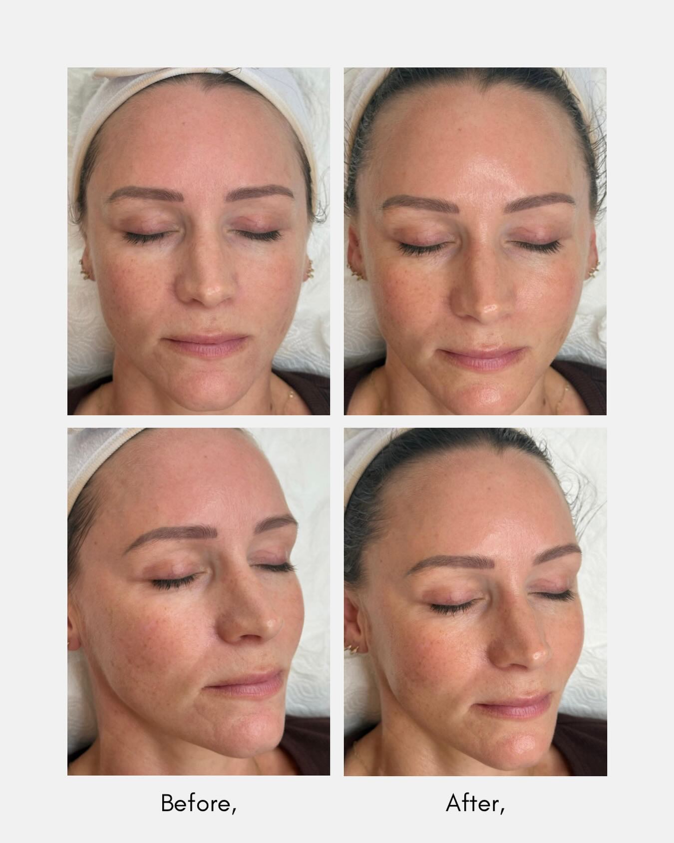 Our Oxygenating Enzyme Peel delivers an instant glow leaving your skin plump, hydrated, and visibly refreshed after just one treatment. This is the perfect pick me up before an event, or if your skin needs a little life breathed back into it.
For best results, we recommend having this treatment every 4 weeks to keep your skin looking fresh, radiant, and healthy!
Give your skin that glow up it deserves ✨