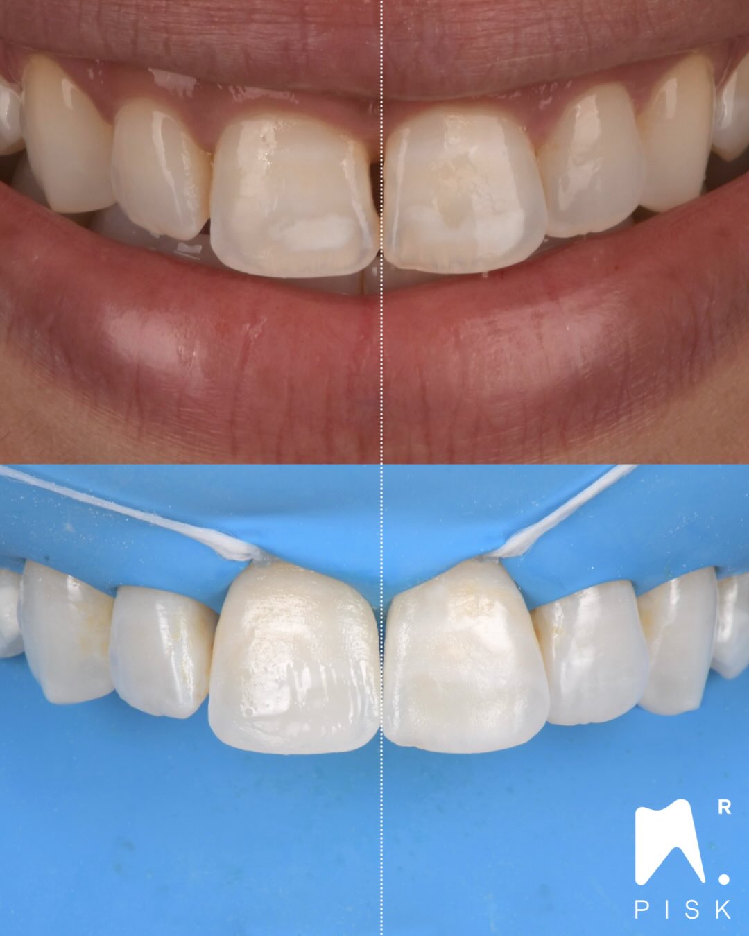 Interesting case of black triangle closure.
Sometime, in order to correct the axis, you need to close only one diastema. Here only on 11. Photoshop smile design help me a lot to know.
We also did an érosion infiltration
Material use :
Gaenial achord A1 for black triangle
Gaenial Universal injectable JE for vestibular enamel