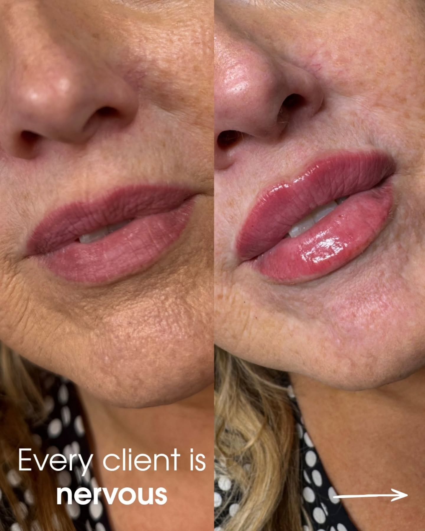 🤍💉 NERVOUS ABOUT LIP FILLER? YOU’RE NOT ALONE 💉🤍
Every single client that walks through my door feels a little nervous at first — and that’s completely normal.
That’s why my approach is always calm, honest, and completely tailored to you. ✨
We talk first.
We plan together.
We go slow.
You’re in control the whole time.
No pressure, no rushing, no surprises — just natural, confidence-boosting results that still feel like you.
And the best part? Seeing that moment when you realise it wasn’t scary after all. 🤍
If you’ve been thinking about it but feeling unsure, message me — I’ll talk you through everything.
#lipfillerswarrington #aestheticswarrington #naturallips #confidenceboost #glowup