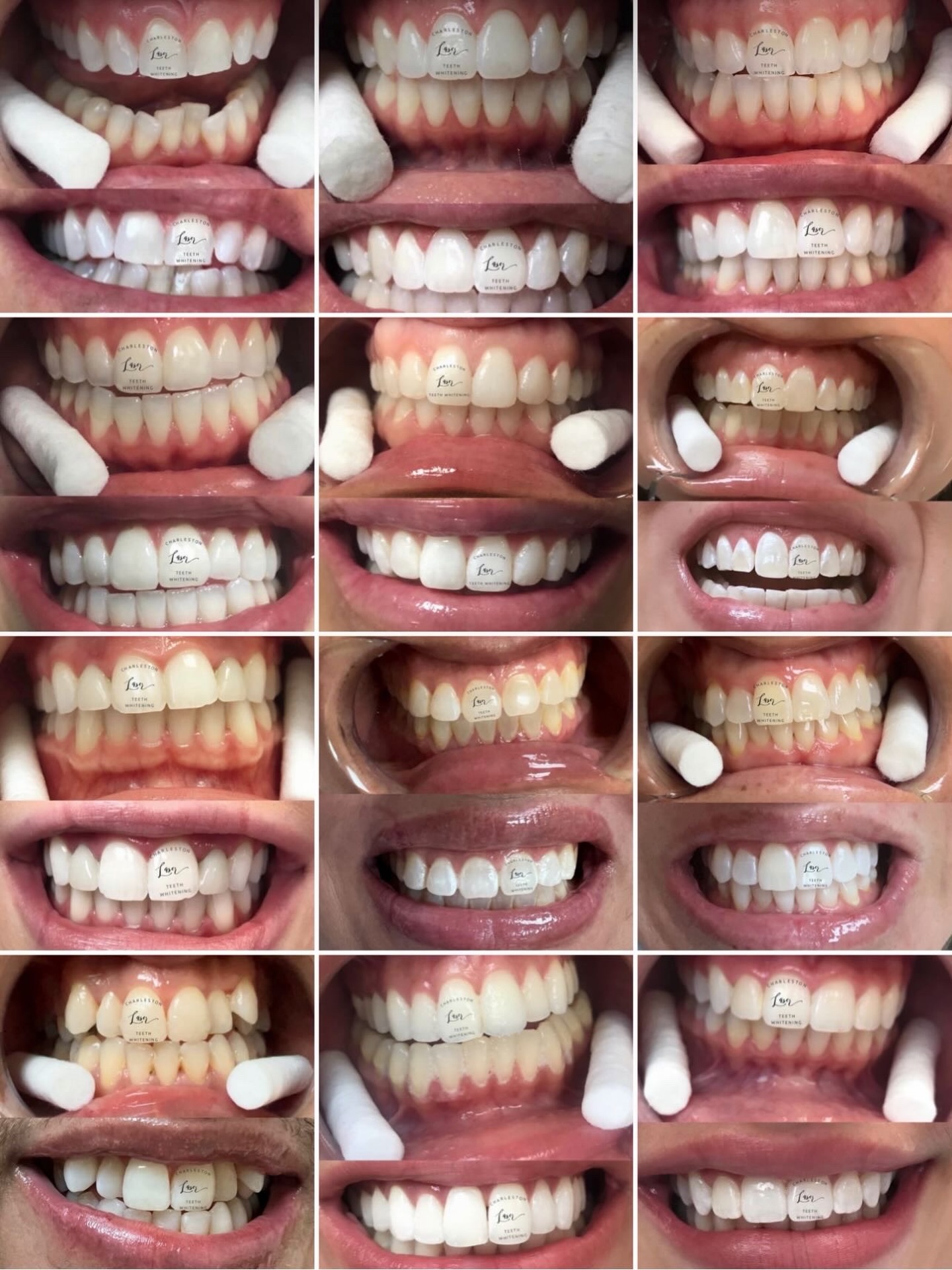 Teeth whitening. It's more than a feeling, it’s how you show up.
Book your teeth whitening now!
www.CharlestonLaserTeethWhitening.com
#teethwhitening #charlestonteethwhitening #charleston #charlestonsc #charlestonlaserteethwhitening mountpleasant mountpleasantsc kiawahisland kiawahjamesisland westashley isleofpalms downtowncharleston sullivansisland johnsisland johnsisland northcharleston northcharlestonsc folly follybeach laserteethwhitening