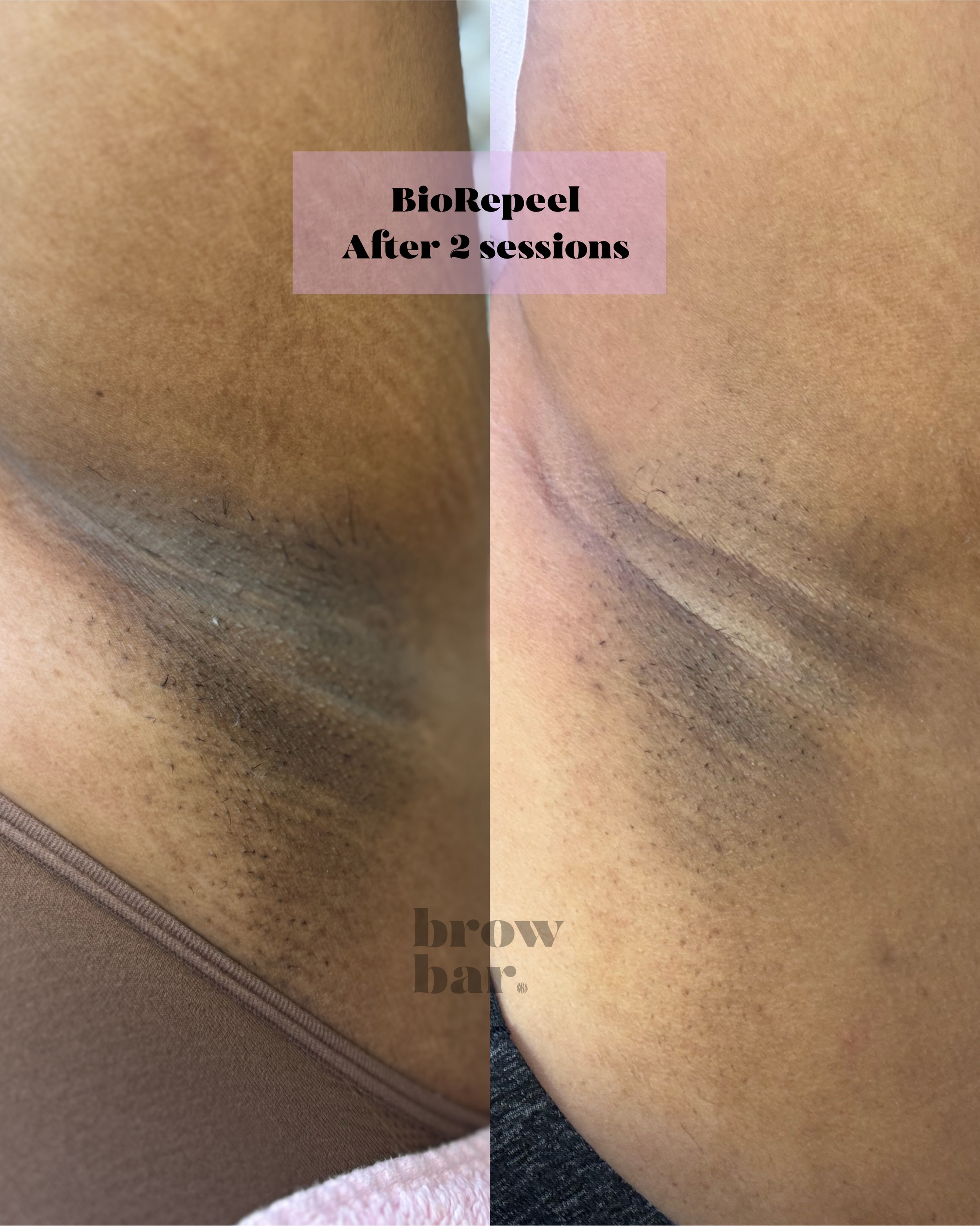 Real results after 2 BioRePeel sessions.
Brighter, smoother underarms with less pigmentation.
✨ Brightens pigmentation
🧴 Smooths skin texture
🧬 Stimulates skin renewal
🧼 Helps clear pores and breakouts
💧 Supports hydration and glow