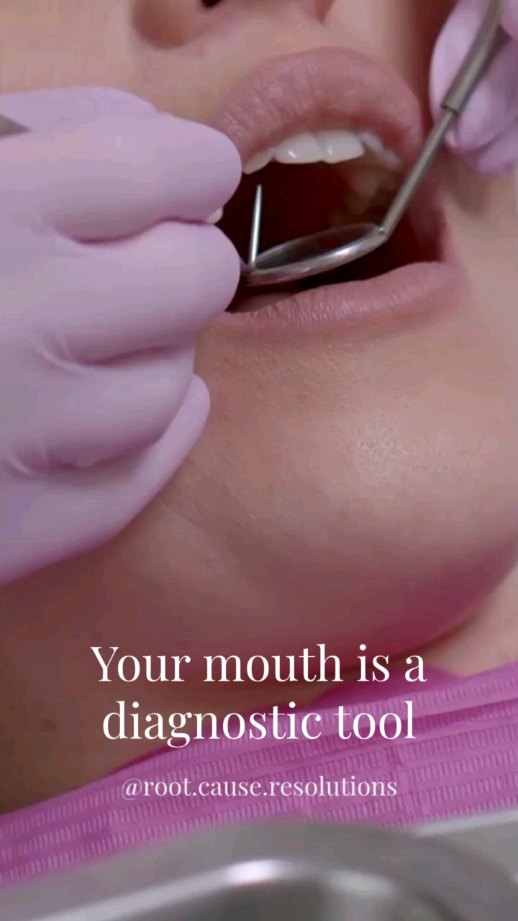 Your mouth is a diagnostic tool.
It’s not just teeth and gums.
I’s a living, dynamic system that reflects what’s happening throughout the entire body.
The oral microbiome alone is a powerful indicator.
✅️ When balanced, it supports immune function, nitric oxide production, and systemic health
❌️ When disrupted, it can contribute to inflammation, cardiovascular disease, metabolic dysfunction, and more.
Bleeding gums, chronic bad breath, recurrent decay...these aren’t isolated issues. They’re signals.
And then there’s structure
➡️Narrow arches
➡️Crowded teeth
➡️Tongue posture
➡️Wear patterns
➡️Tissue tone
➡️Airway space
These aren’t just aesthetic findings.
They’re functional clues that can point to mouth breathing, sleep-disordered breathing, improper muscle function, and compensation patterns that have developed over time.
💥 What you see intraorally often reflects what’s happening with breathing, sleep, and overall physiologic stability.
If you’re only looking for cavities, you’re missing the bigger picture.
🌟 Start reading the mouth differently, and you’ll start seeing the patient differently.
#airwaydentistry #wholebodyhealth #oralhealth #myofunctionaltherapy #RDH