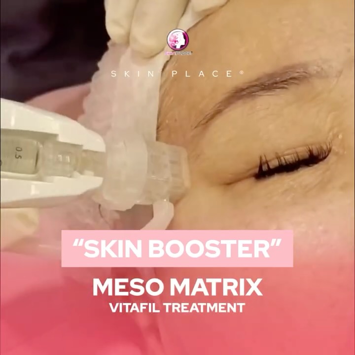 Elevate Your Glow with Skin Place “Skin Booster” – MESO MATRIX – Vitafil Treatment! ✨💧
Experience the ultimate hydration experience! Our signature skin booster is designed to deeply nourish the skin, promoting a smoother texture and a resilient, healthy-looking appearance. Achieve that coveted plump, dewy, and radiant finish you love.
Perfect for anyone looking to maintain a refreshed and vibrant complexion. Book your session today and let your inner radiance shine! 💖
Skin Place is Your Skin's Place.
✨ See comment section for more details! ✨
#SkinPlace #SkinBooster #Vitafil #MesoMatrix #HydratedSkin #GlowingSkin #RadiantSkin