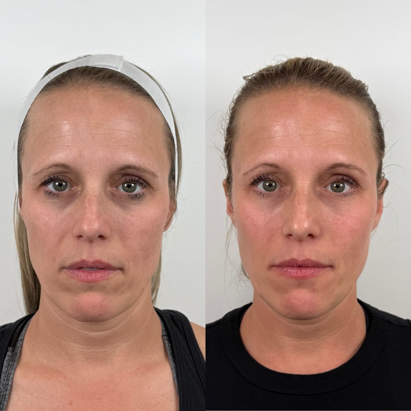 When everything else stays a priority, time for yourself can be harder to find.
This patient is a fellow local business owner and busy mom, so when she came in, we approached her treatment plan together @rachel_facaesthetics… treating temples, cheeks, under eyes, nasolabial folds, preauricular area, chin, and chin shadow.
Nothing overdone, nothing obvious… just small, well-placed adjustments to restore lost volume and bring back what time naturally changes.
Her results are what most people are looking for… you wouldn’t know she had anything done. She just looks more rested, more restored, and like herself. That’s the difference with facial balancing—it’s how everything flows together.
This level of work comes from experience, restraint, and knowing when and where to treat.
If you’ve been hesitant because you want natural, not obvious, this is exactly where we start.
#FacialBalancing #NaturalResults #RefreshedNotOverdone #SubtleEnhancements #AestheticMedicine #DallasMedSpa #dfwaesthetics #FĀCAesthetics