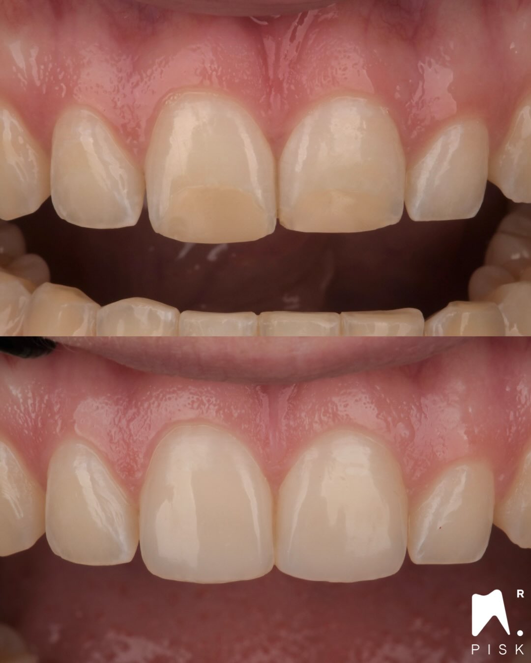 LAYERING & INJECTION
You want to learn this technique ?
Material :
Gaenial Universal injectable : AE, JE
Gaenial achord : A1 OA2
Empress direct color opaque