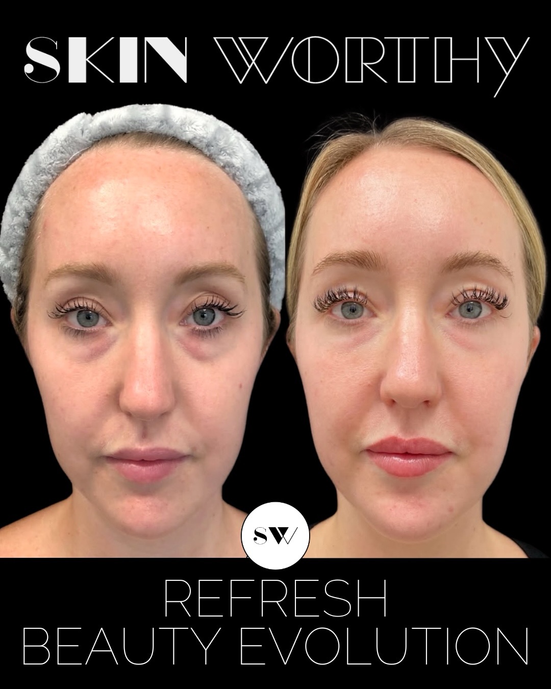 On your wedding day, you deserve to feel confident, radiant, and truly like yourself at your very best 👰♀️✨
Our gorgeous patient Kayla has trusted us with her skin for years, and we were so excited to be part of her wedding prep journey. Her main goal was improving skin quality, so we created a customized plan including a series of 3 #Morpheus8 treatments paired with #Evoke to tighten and strengthen the face and submental area.
We also enhanced facial balance and restored volume with a thoughtful combination of dermal fillers and tox. To complete her #BridalEvolution, we finished with a dermal infusion—leaving her skin glowing and perfectly prepped for her wedding day makeup 💫
Ready to start your own bridal journey? Call or text us at 647-350-7546 🩷🩷🩷