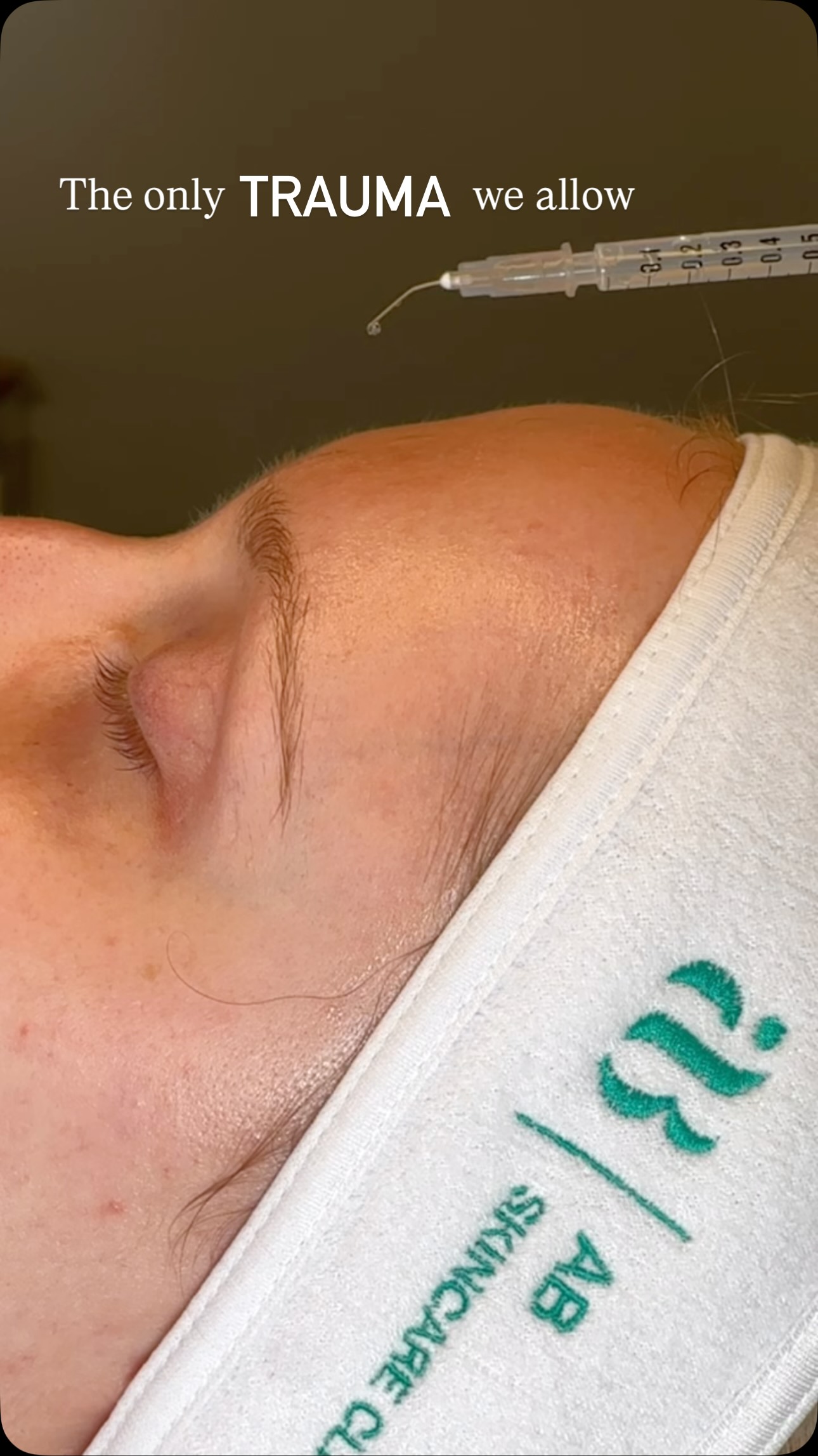 Is clinically controlled…
Microneedling works by creating controlled micro-injuries within the skin.
This process activates the body’s natural wound-healing response. In turn; increasing collagen and elastin production, improving cell turnover, and strengthening the skin’s overall structure.
This translates to:
• Improved skin texture and tone
• Reduction in fine lines and acne scarring
• Enhanced firmness and resilience
It’s not about damaging the skin, it’s about stimulating precise regeneration.
If you’re looking for evidence-based skin rejuvenation, microneedling is a proven option.
That’s why it’s the only trauma we allow @abskincareclinic
#Microneedling #CollagenInductionTherapy #EvidenceBasedSkincare #SkinRemodelling AestheticClinic
Skinclinictalbotgreen
Skincarespecialistsouthwales
Acnespecialist
Anti-agingtreatment
Collagenbanking
Acnescarringtreatment