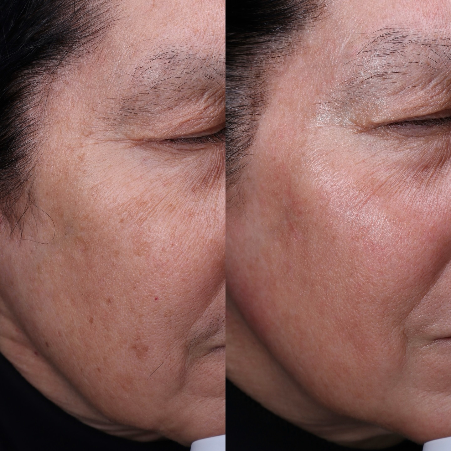 BBL + MOXI, the “magic eraser” treatment.
Years of damage, erased by this incredible technology we use daily to make our clients feel better in their own skin.
⚡️Treatment duration: numbing + treatment - about an hour.
⚡️Treatment cost: $1000/treatment, $2,700/3 treatments- for face + neck + exosomes + aftercare products
⚡️Treatments needed: a series of 3 are recommended if you never treated the concern before, and an average of once a year for maintenance and to treat potential new pigment
⚡️Pain level: varies based on pain tolerance, but our prescription numbing cream makes everyone pretty comfortable during the treatment. If you ask me, I’d say it’s a 6-7, I can’t tolerate pain very well.
⚡️Treatment downtime: redness the day of, puffiness next morning, “sandpaper” texture for 5-6 days.
⚡️Best candidates: pigmentation (brown, red, or both), texture, scars
#bbl #moxi #bblmoxi