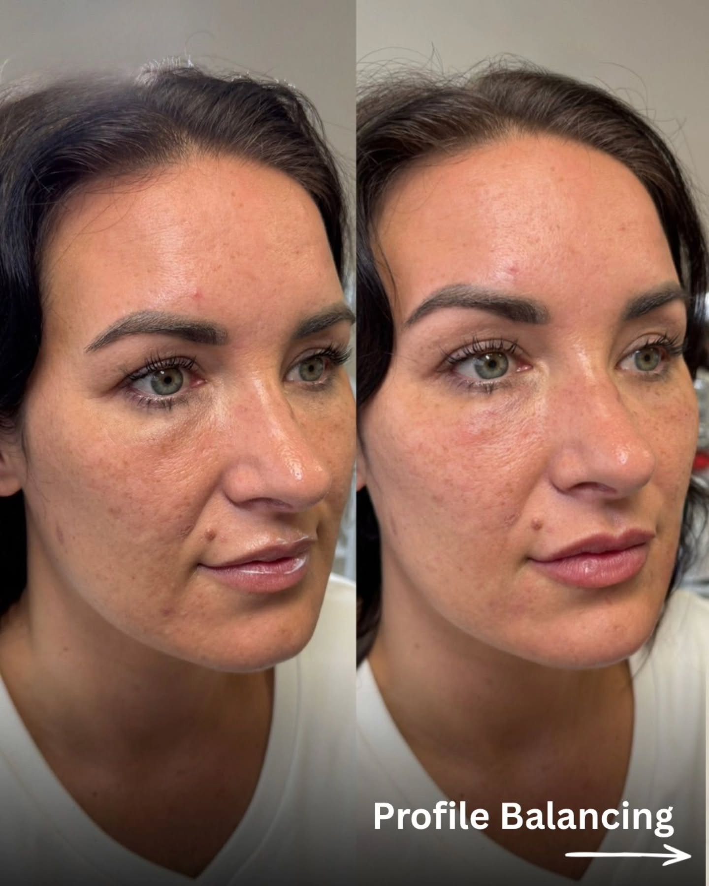 ✨ SUBTLE TWEAKS, REAL BALANCE ✨
It’s not about changing your face — it’s about restoring harmony.
Soft volume, refined contours, and natural results that still look like you… just more refreshed.
Less obvious. More intentional. Always undetectable.
Comment “ME” if you’re ready to find your perfect balance. ✨
#profilebalancing #naturalenhancement #subtletweaks #facialaesthetics #aestheticswarrington