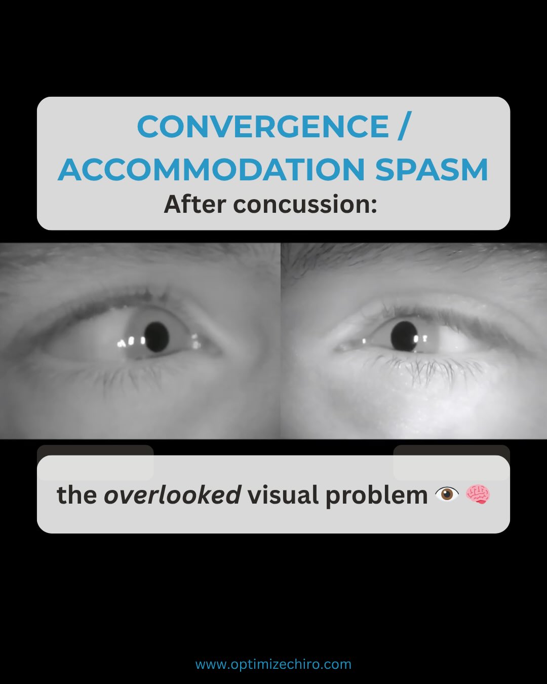 Convergence and accommodation spasm is an under-recognised contributor to persistent post-concussion symptoms.
While most clinicians look for “insufficiency,” some patients present with the opposite problem — an overactive, dysregulated near reflex driven by central nervous system dysfunction.
This has major implications for:
• Diagnosis
• Rehabilitation
• Recovery timelines
Objective tools like video oculography are critical to detect what standard bedside testing often misses.
#concussion #visiontherapy #vestibularrehab #neurorehab #sportschiropractic